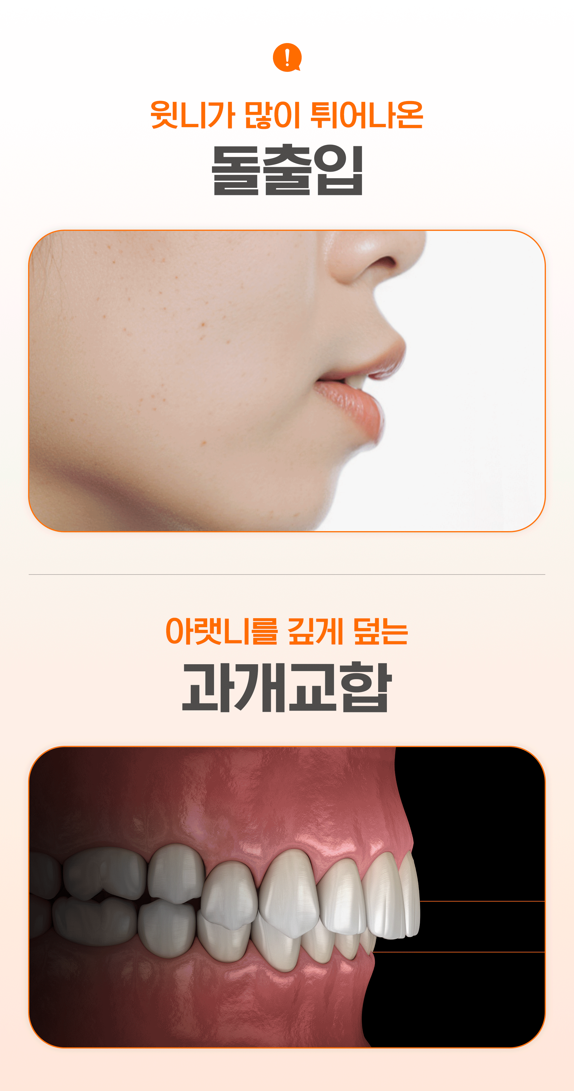 성장기 교정이 필요한 상황 중,돌출입과 과개교합을 표현한 의학적 일러스트