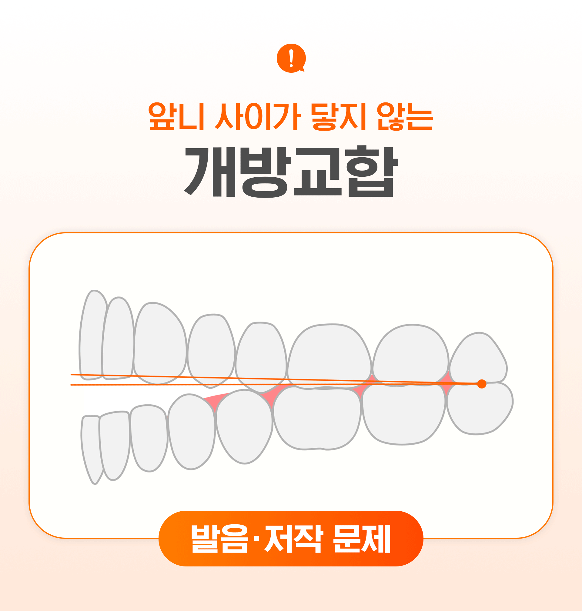 성장기 교정이 필요한 상황 중 개뱡교합을 표현한 이미지