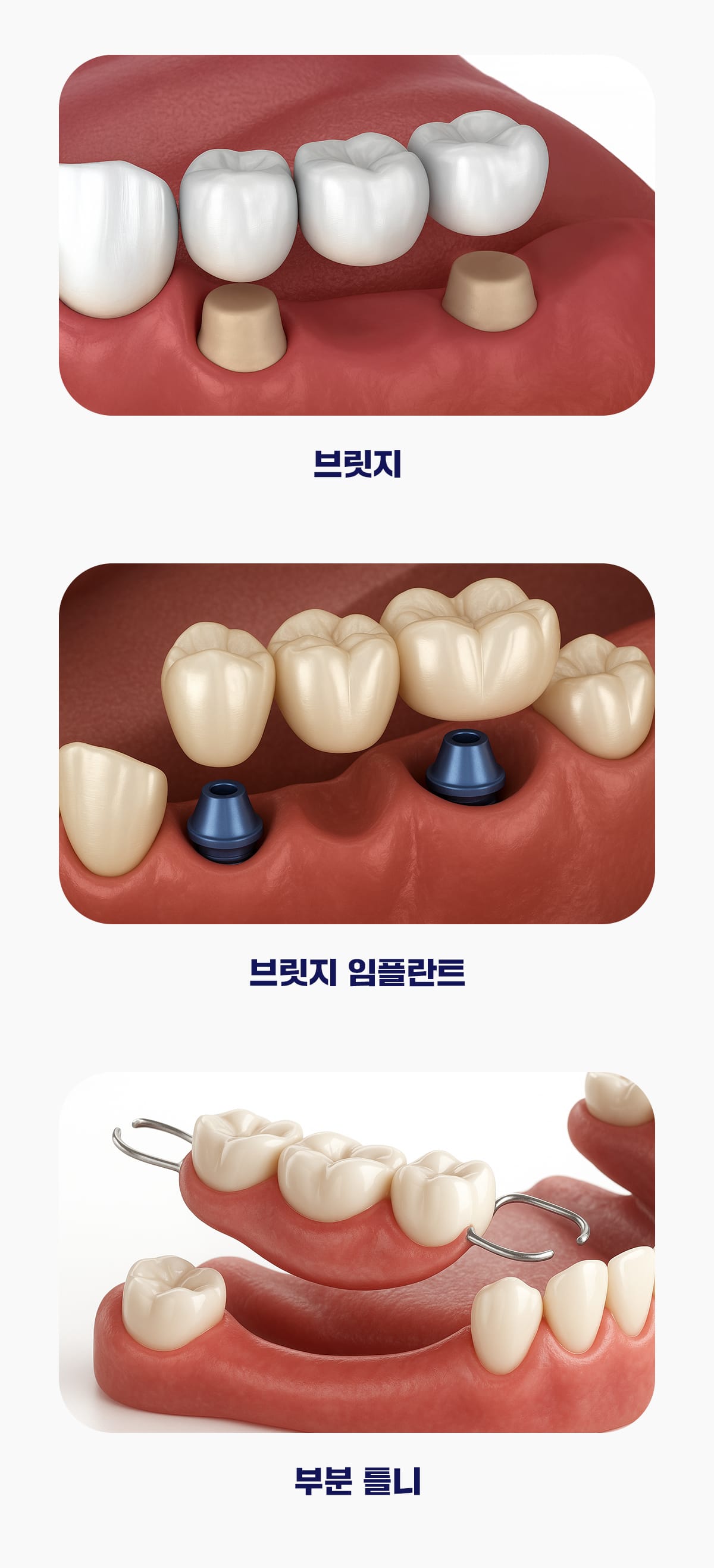 브릿지, 브릿지 임플란트, 부분틀니 비교 이미지