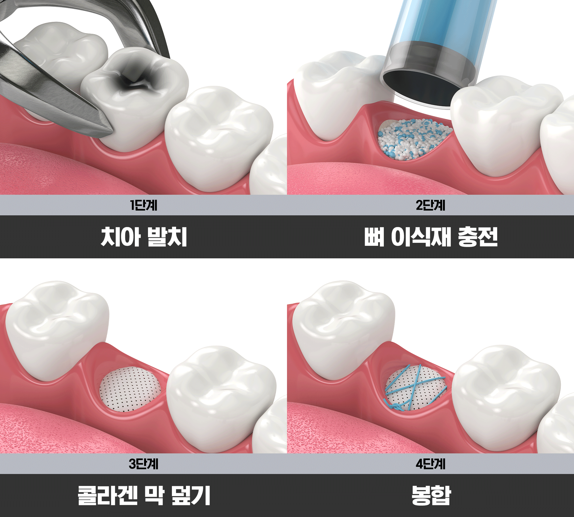 뼈이식을 위한 발치와 보존술 관련 인포그래픽