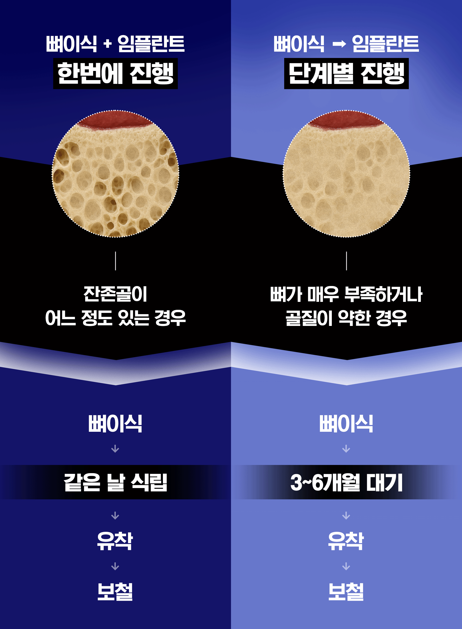 일반 임플란트와 뼈이식 임플란트의 과정을 비교해 나타낸 인포그래픽