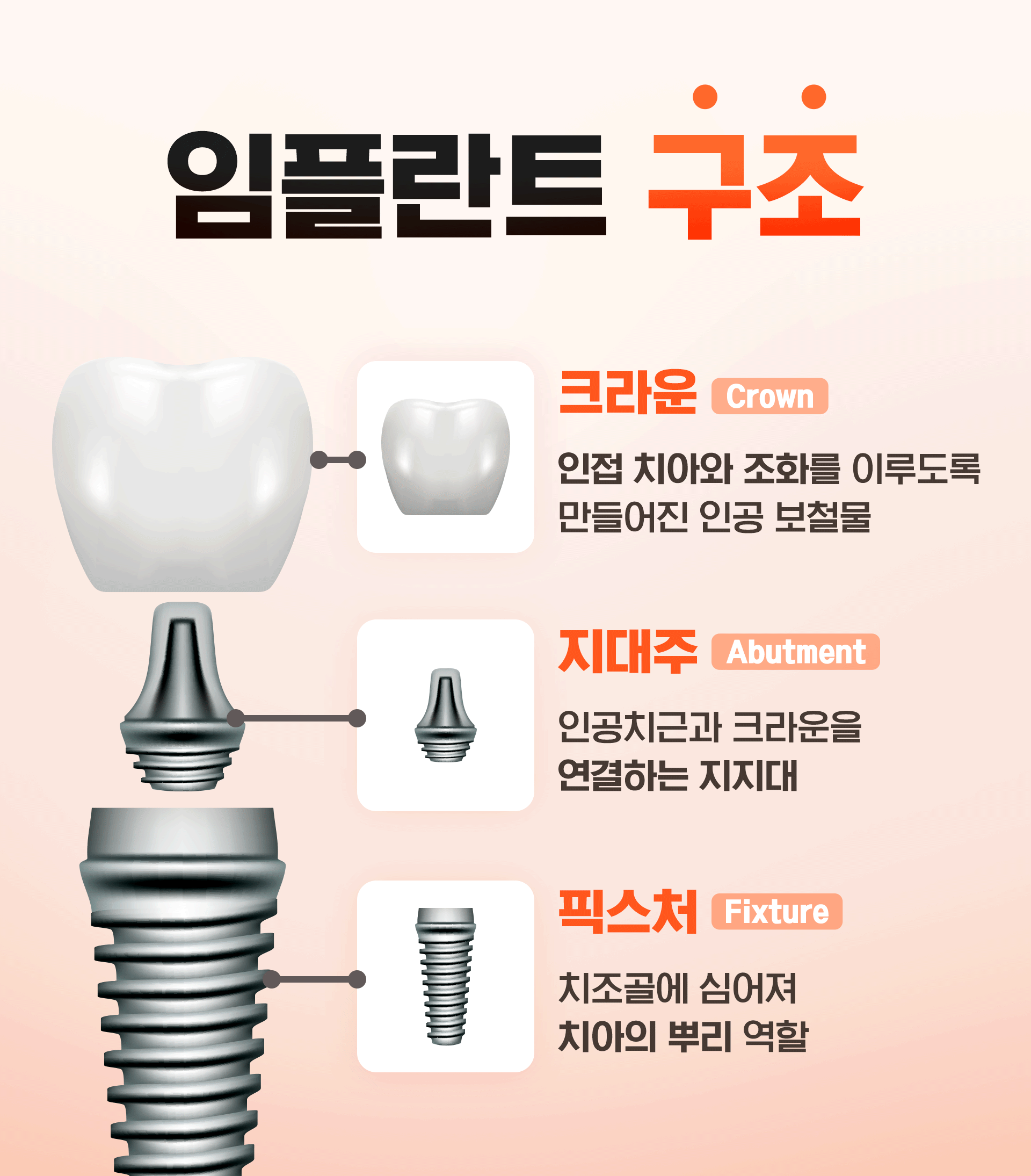 임플란트 구조를 나타낸 인포그래픽
