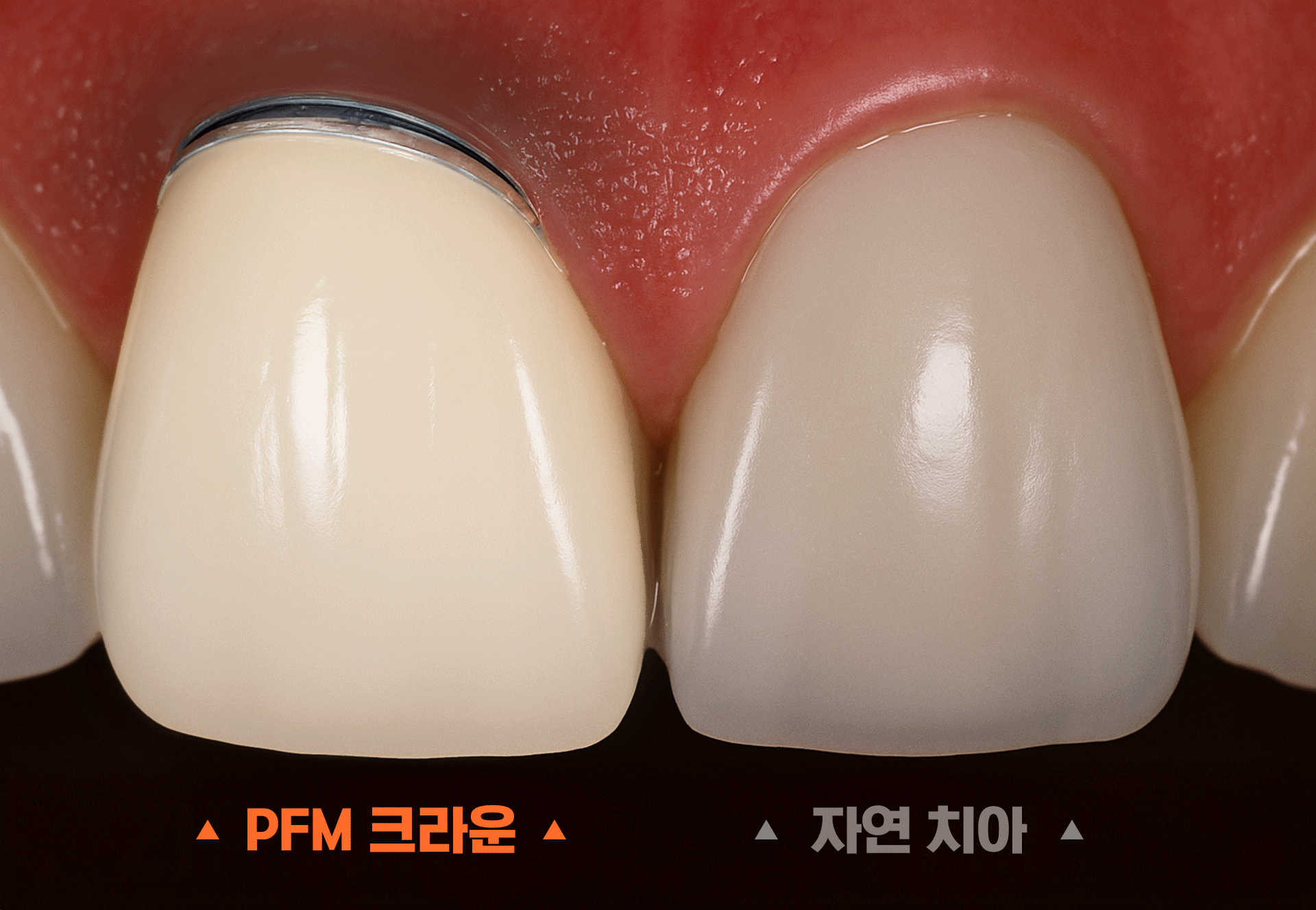 PFM 크라운과 자연치아의 색상 비교 이미지