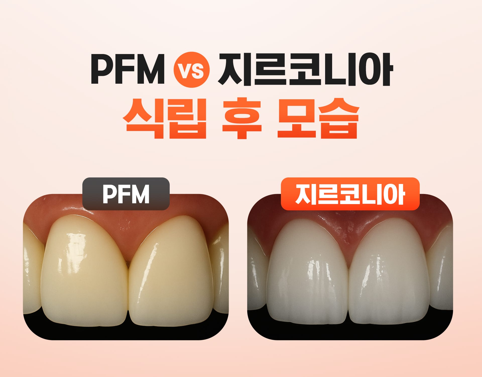 PFM vs 지르코니아의 식립 후 모습을 표현한 이미지