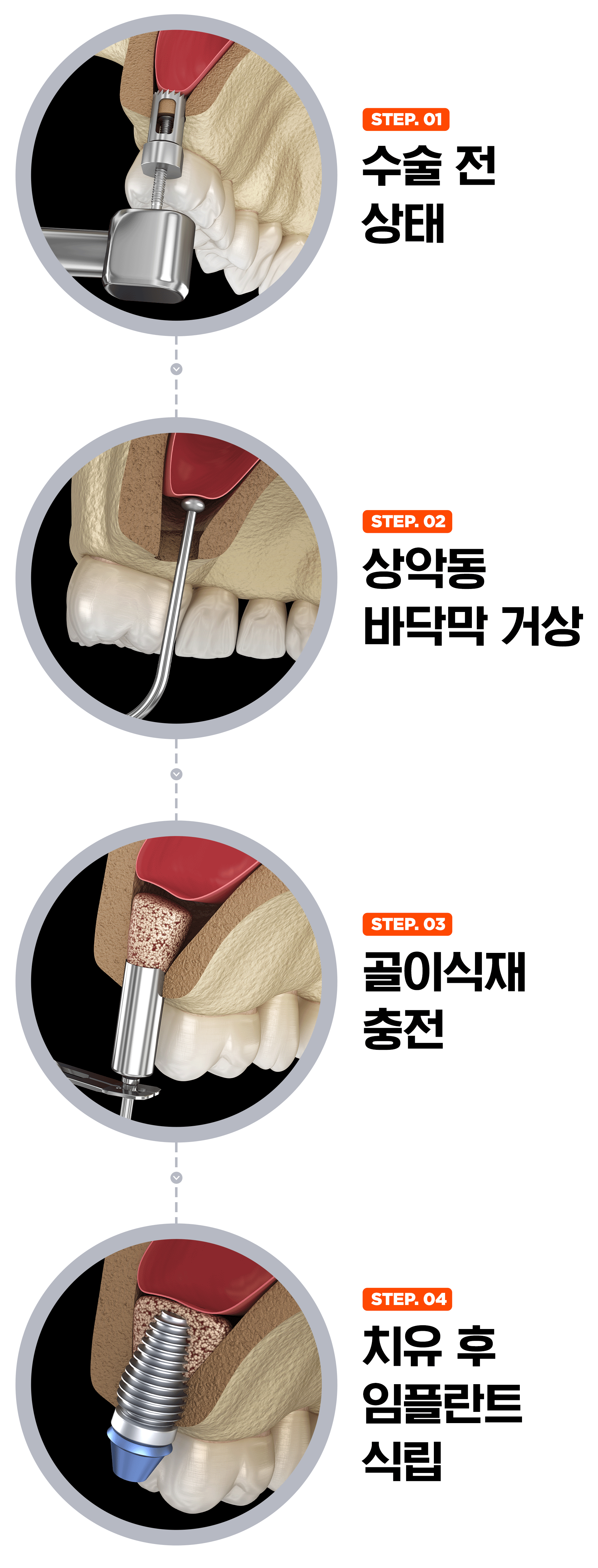 상악 잇몸뼈가 부족 시에 실행해야 하는 상악동 거상술의 절차를 나타내는 이미지