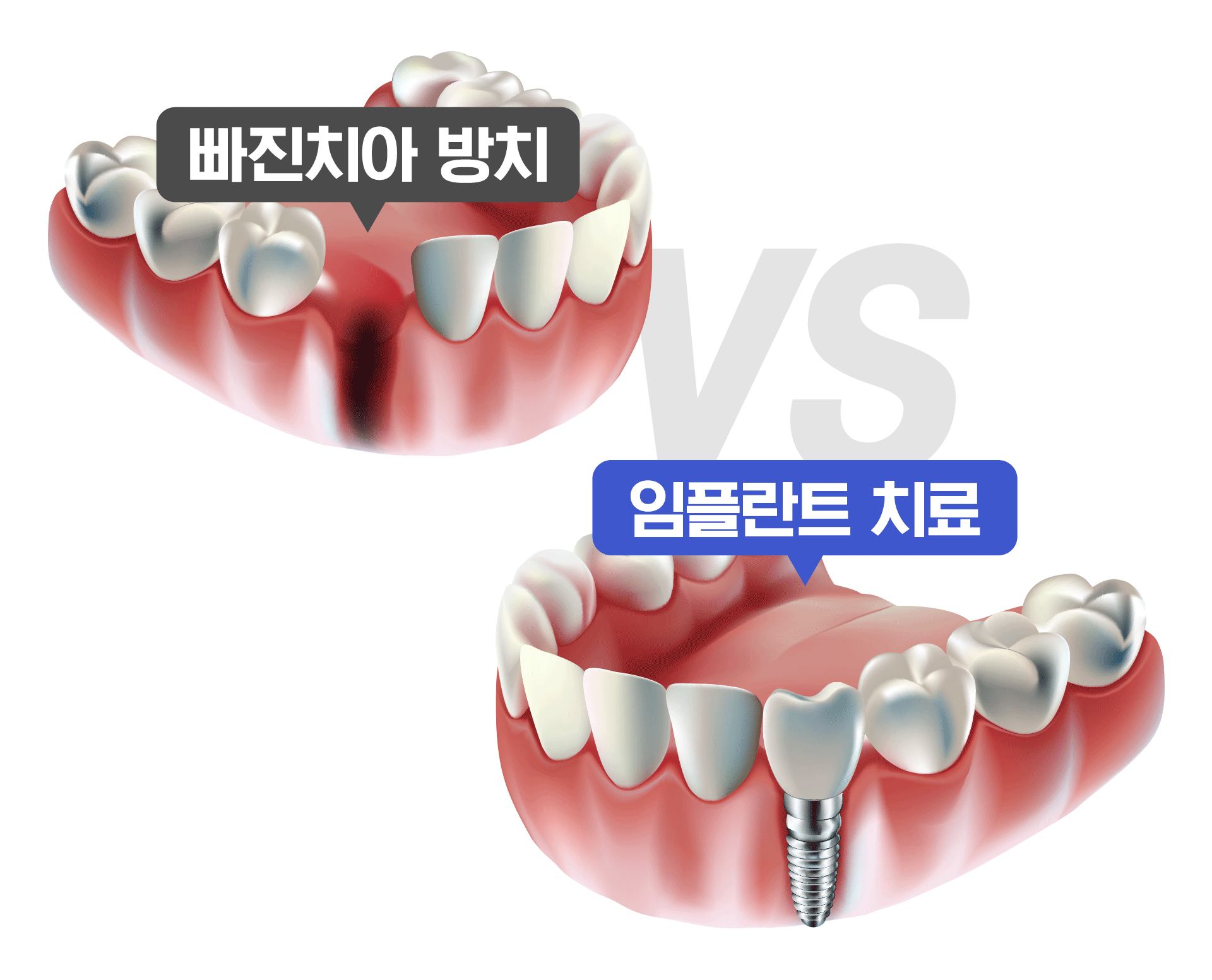 빠진 치아와 임플란트 치료를 비교한 이미지
