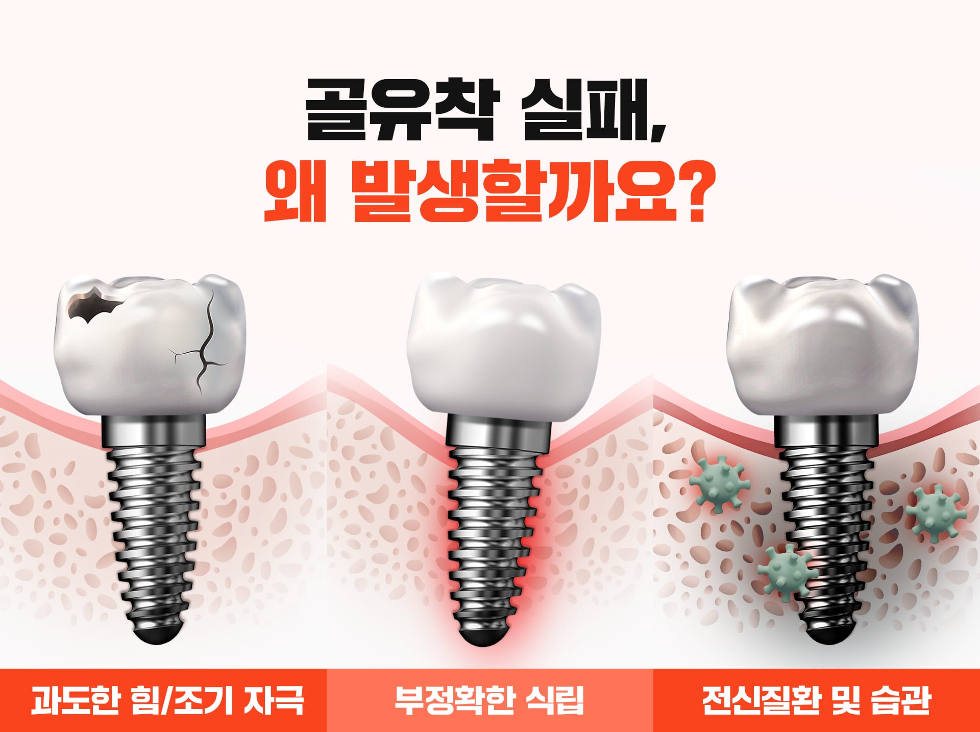 임플란트 재식립의 원인인 골유착 실패의 과정을 나타낸 이미지