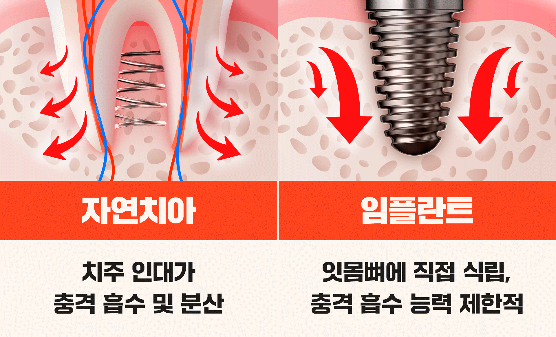 임플란트 재식립 원인 중 하나인 딱딱하고 질긴 음식을 즐기는 습관을 의학적으로 설명한 이미지
