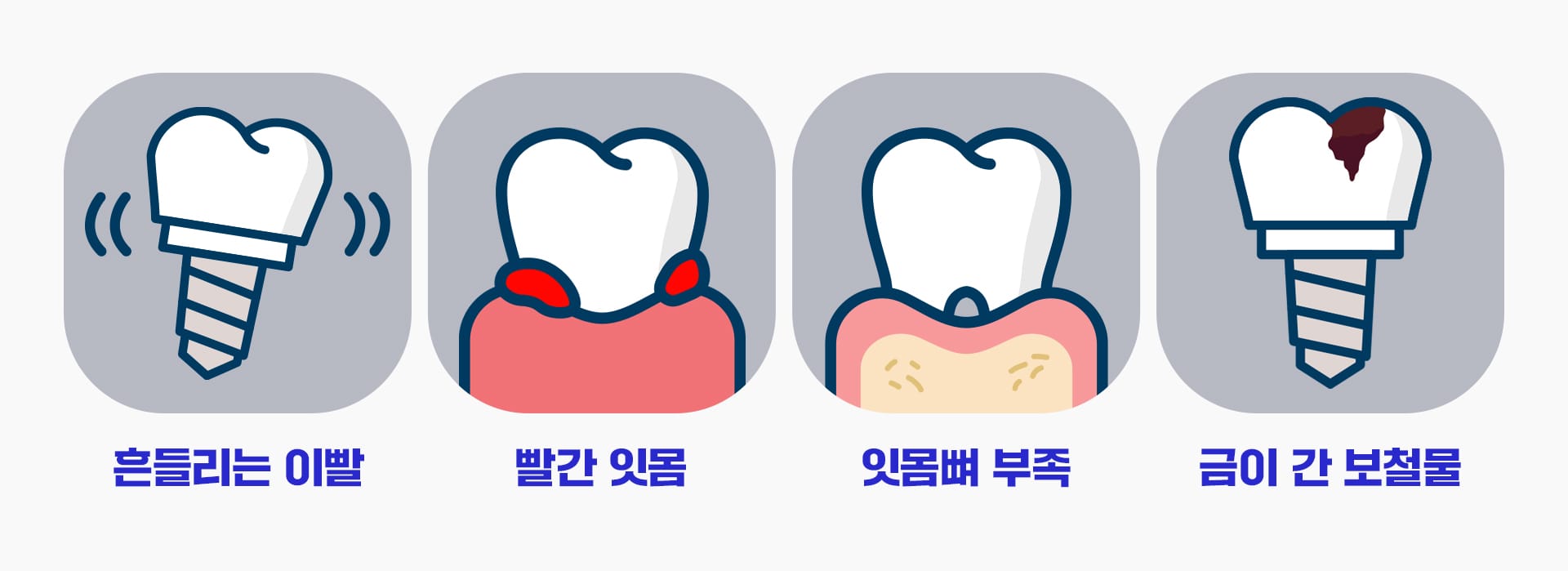 임플란트 재수술이 필요한 4가지 주요 증상