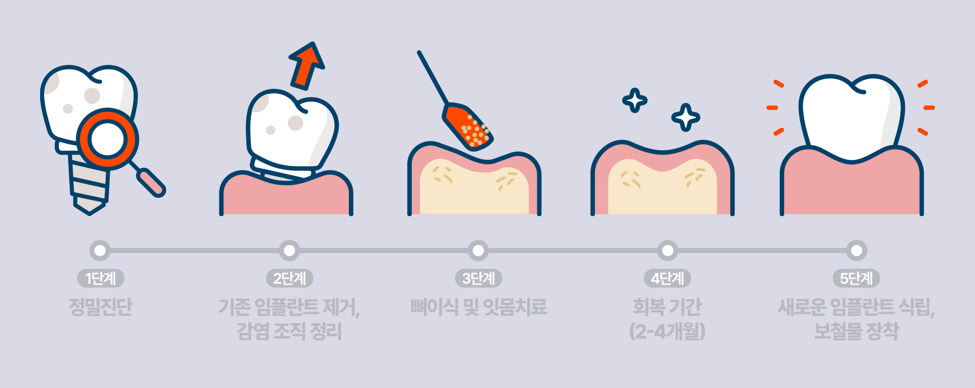임플란트 재수술, 정밀 진단부터 수술까지 과정