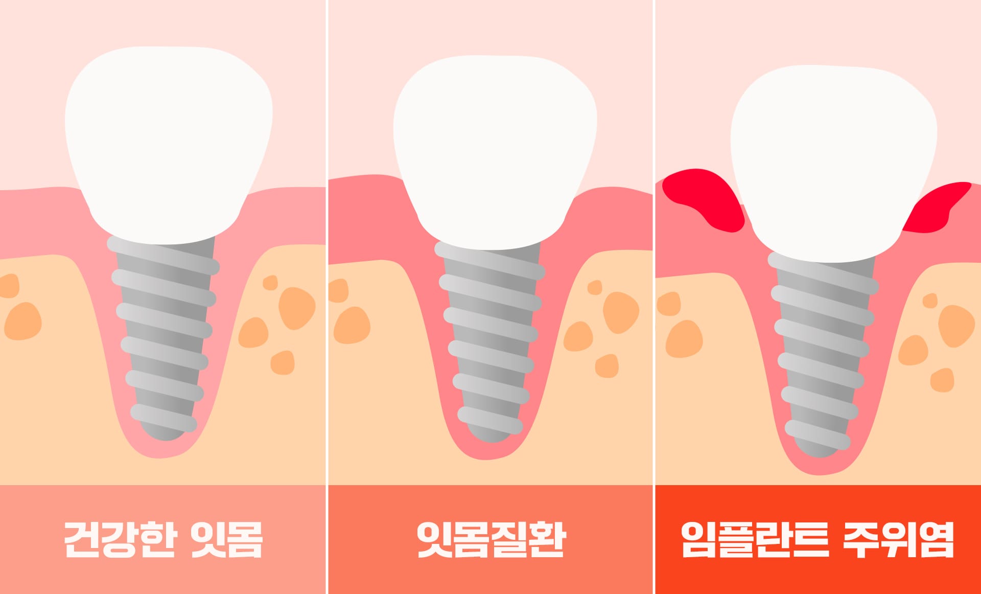 당뇨가 잇몸에 미치는 영향을 보여주는 인포그래픽