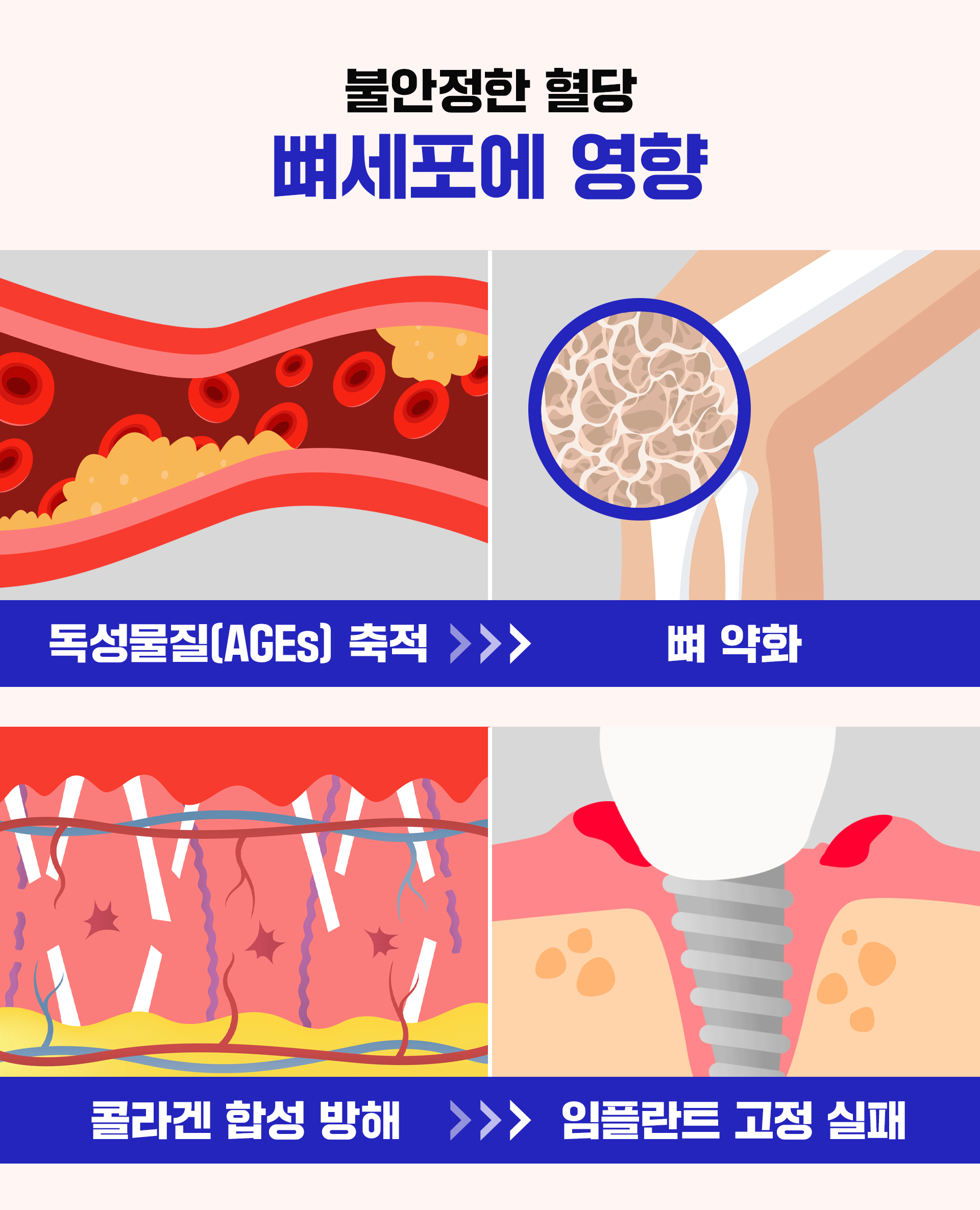 불안정한 혈당이 뼈세포에 주는 영향을 표현한 이미지