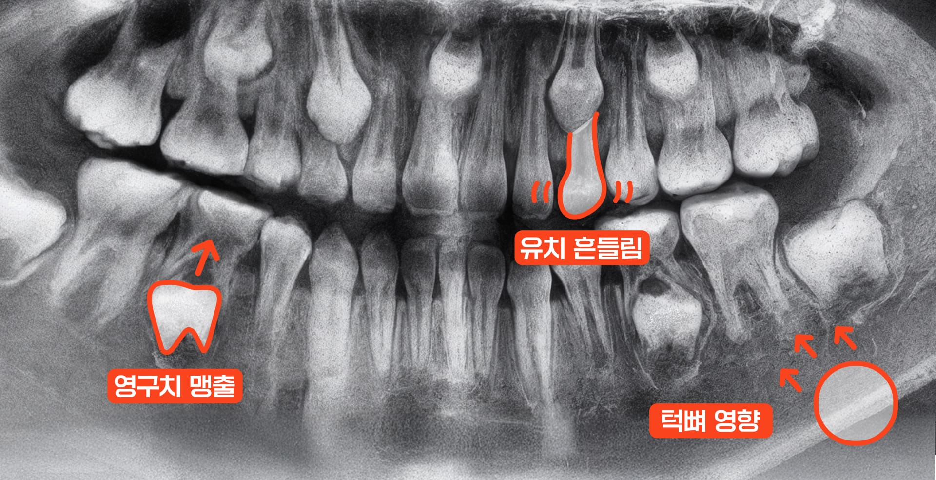 성장기 교정을 위해 유치, 영구치, 턱뼈 영향을 표시한 X-ray 이미지