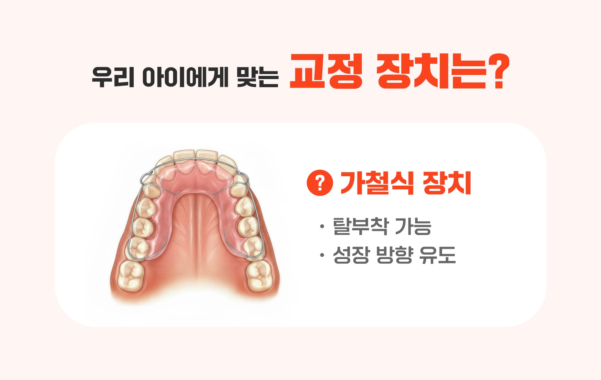 성장기 교정 아동에게 맞는 교정장치를 표현한 첫번째 인포그래픽