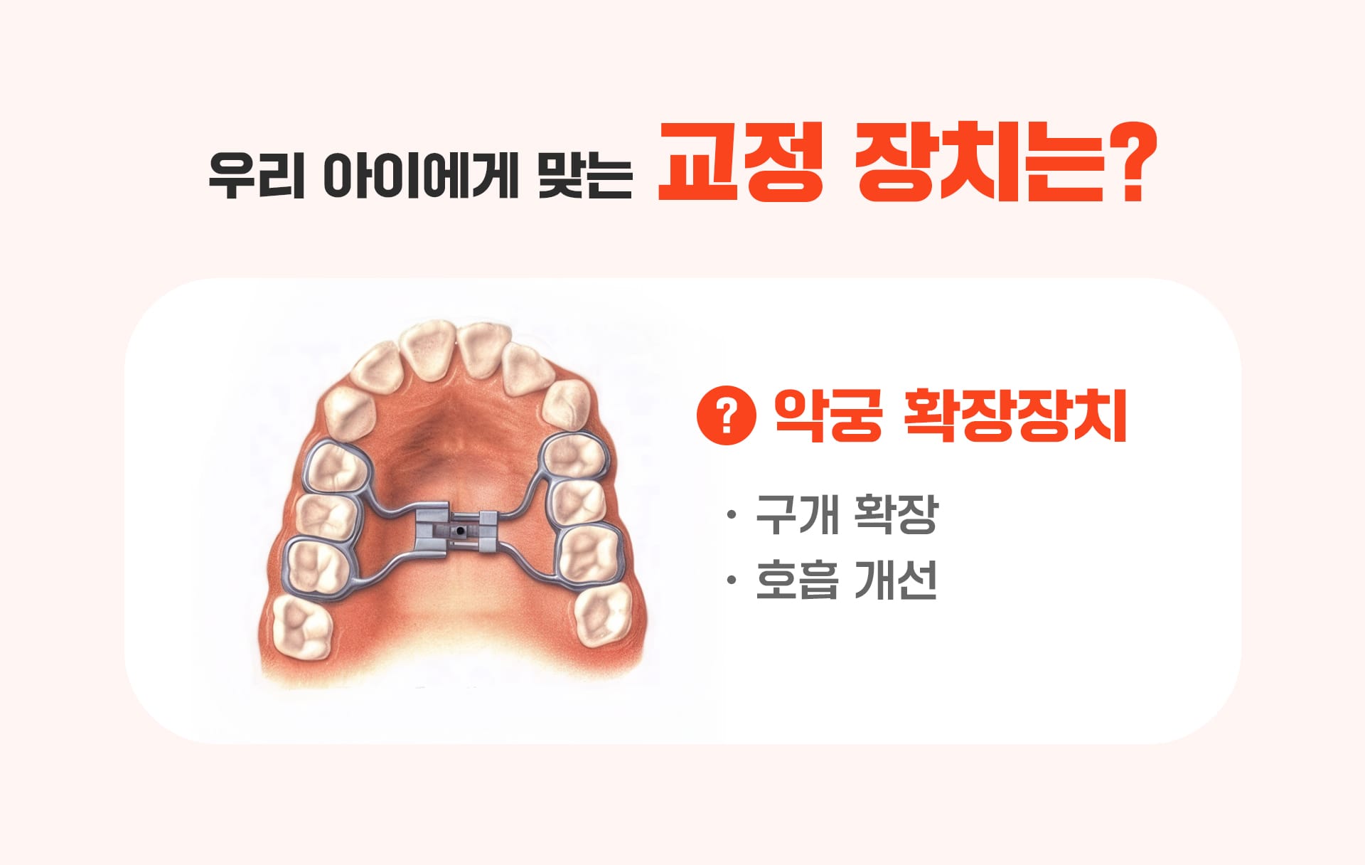 성장기 교정 아동에게 맞는 교정장치를 표현한 두번째 인포그래픽