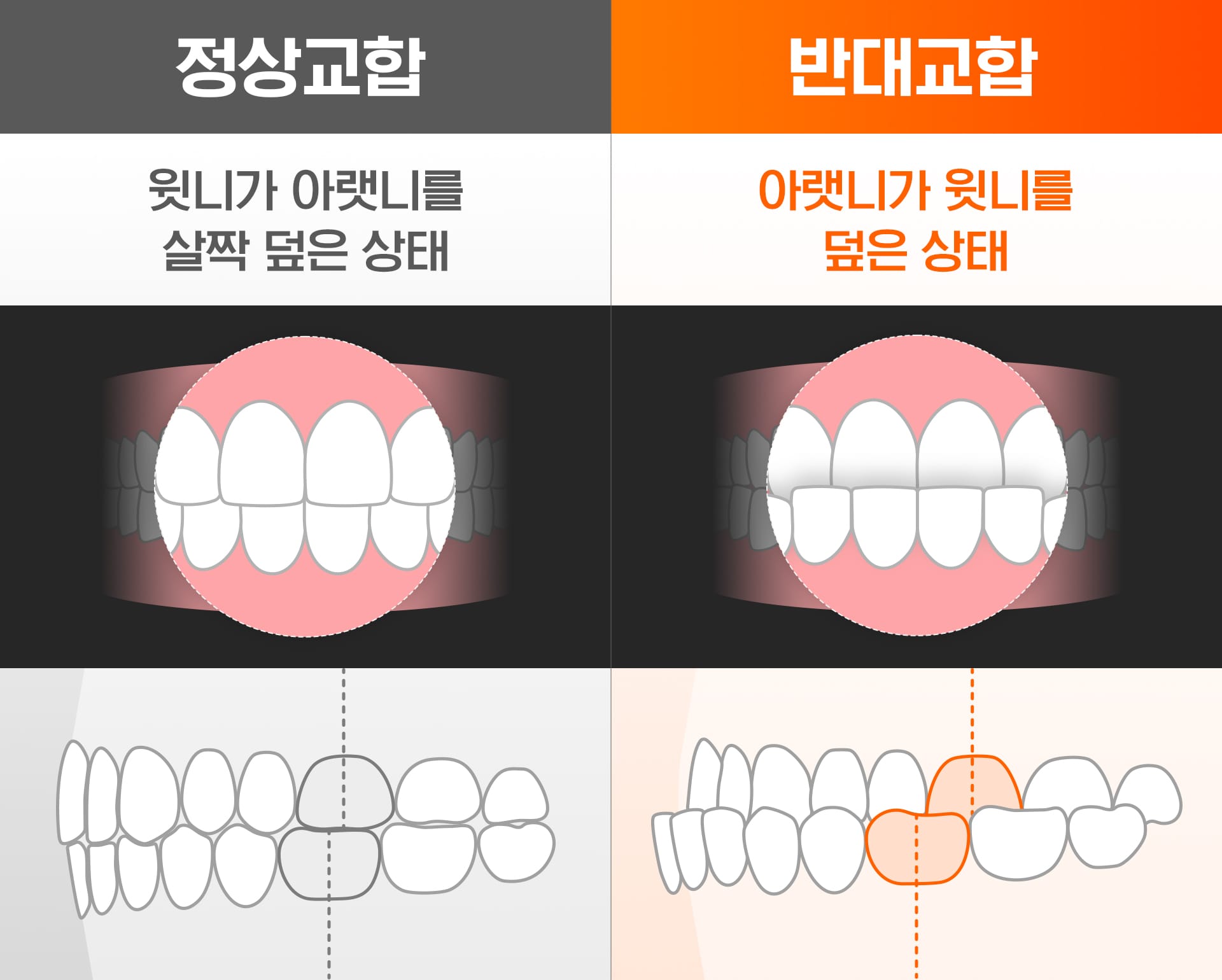 성장기 교정 중 반대교합을 정상교합과 비교한 인포그래픽