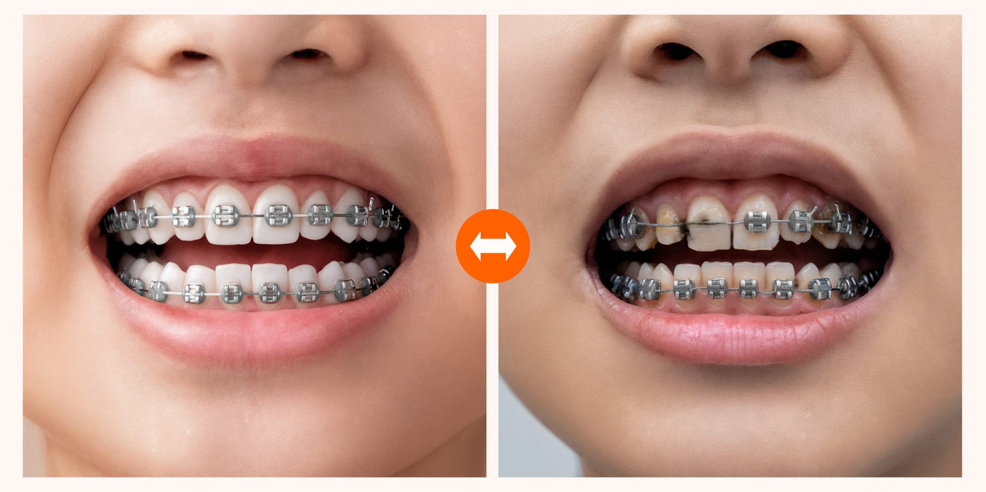 어린이 치아교정 중 부적절한 식습관으로 장치가 손상될 수 있음을 보여주는 이미지 