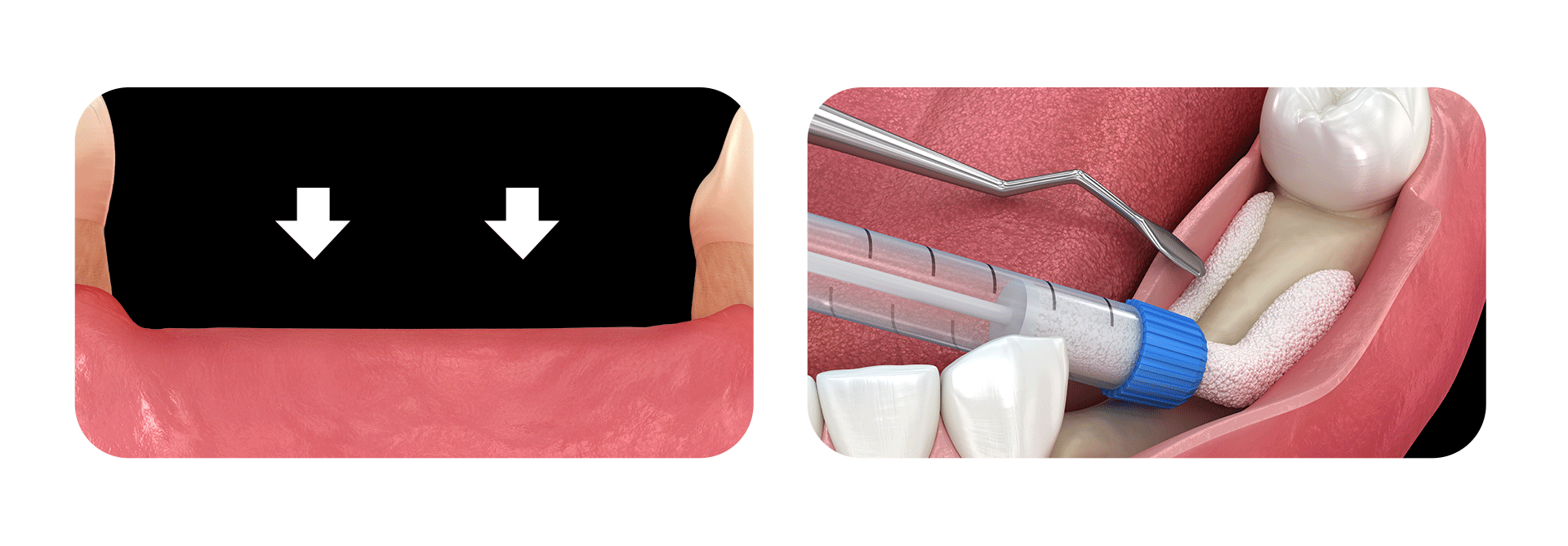 잇몸뼈 상실이 심하게 진행되어 뼈이식을 진행하고 있는 이미지 