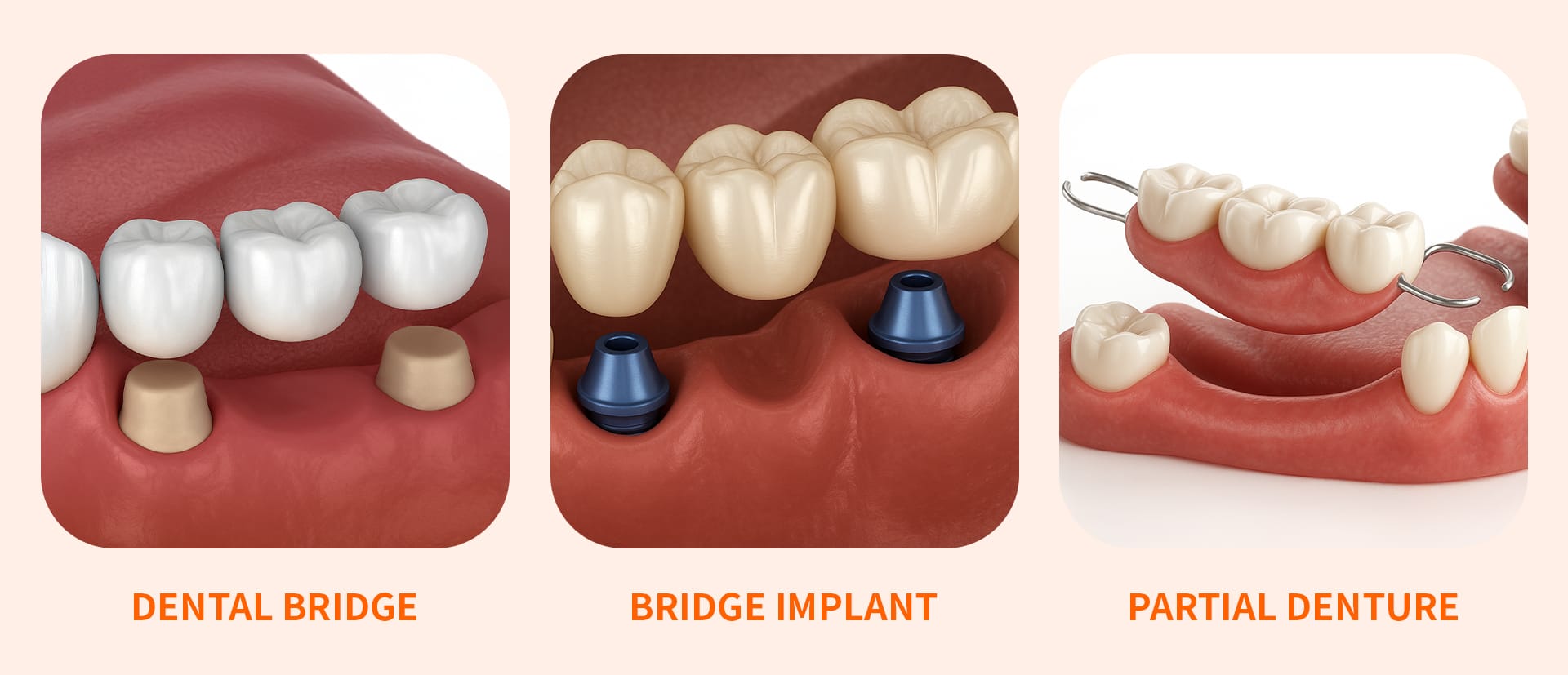 부분틀니(Partial Denture), 브릿지(Dental Bridge), 브릿지임플란트(Bridge Implant)을 비교한 인포그래픽