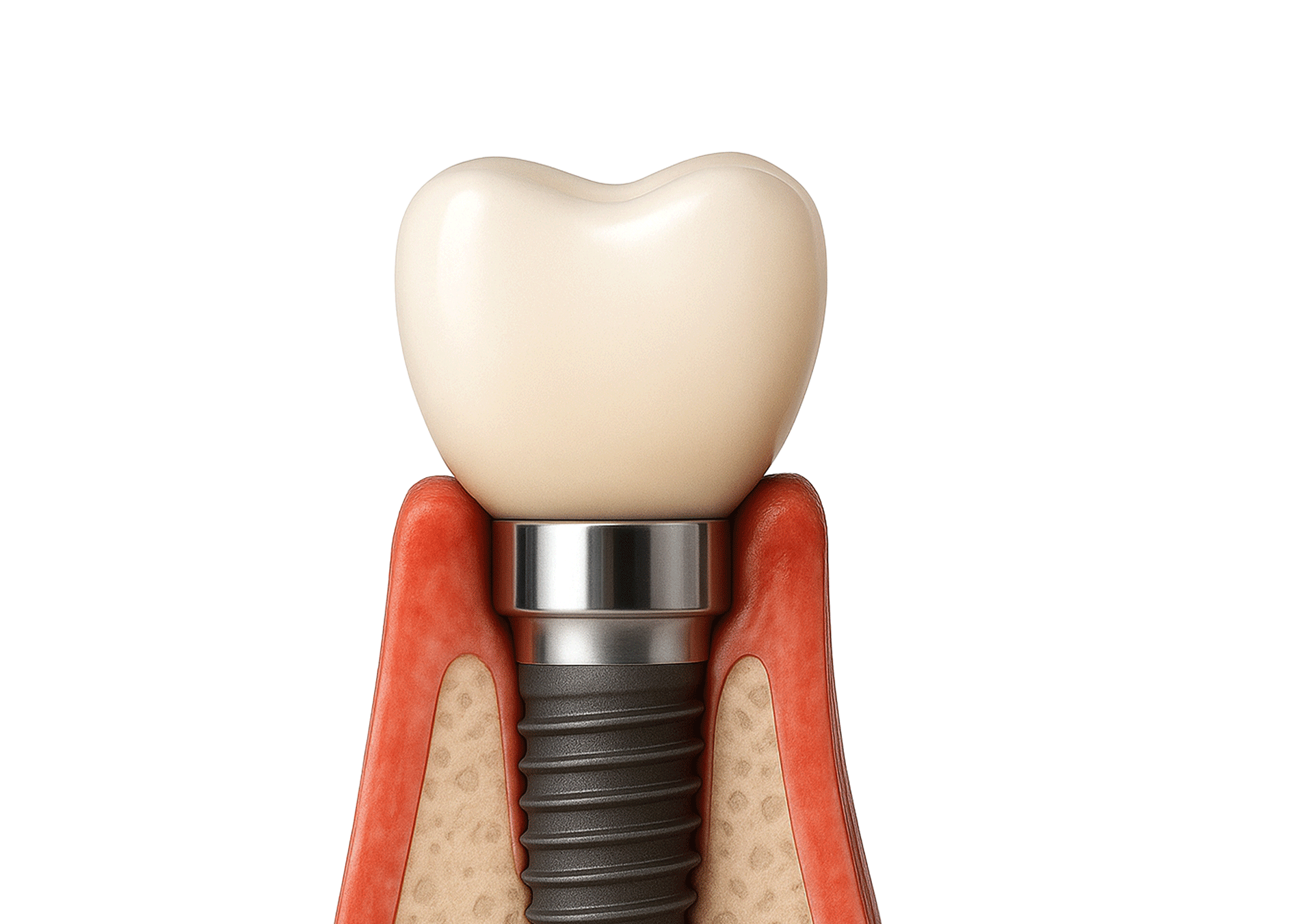 뼈이식 실패로 인해 뼈가 흡수되거나, 이식 부위에 염증이 생겨 녹아 없어짐을 보여주는 이미지 