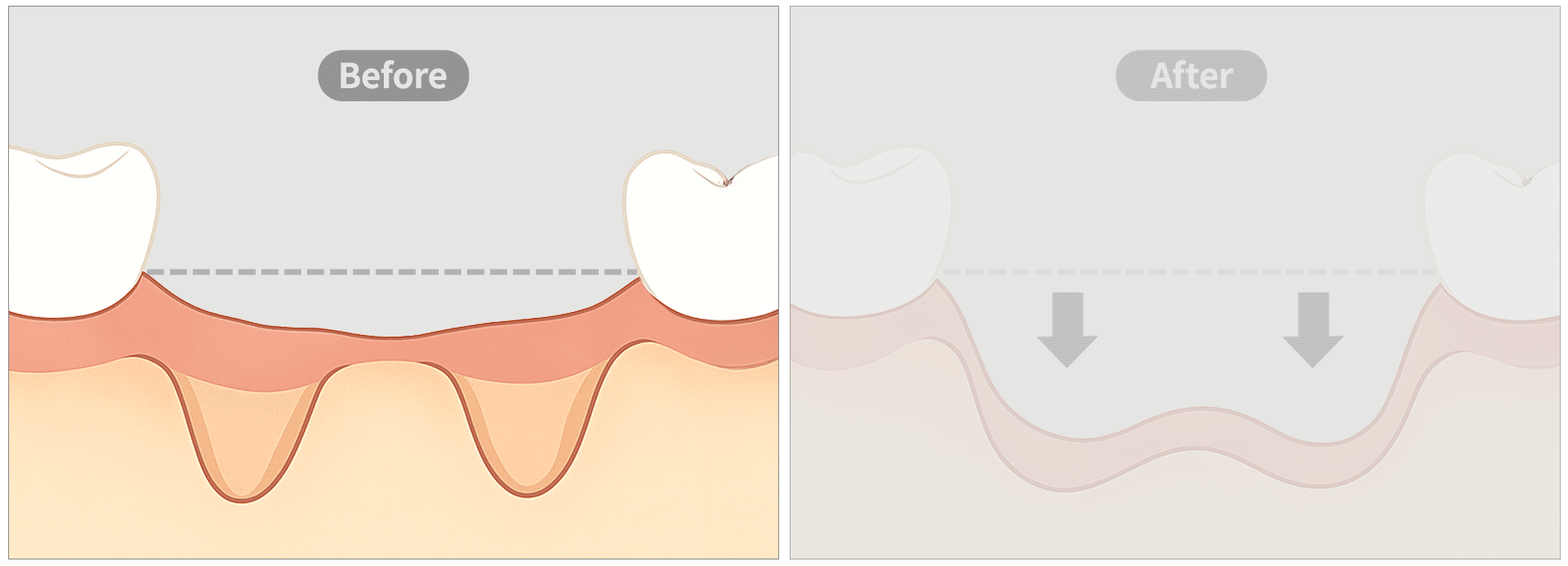 歯槽骨が吸収していく前後を比較した画像