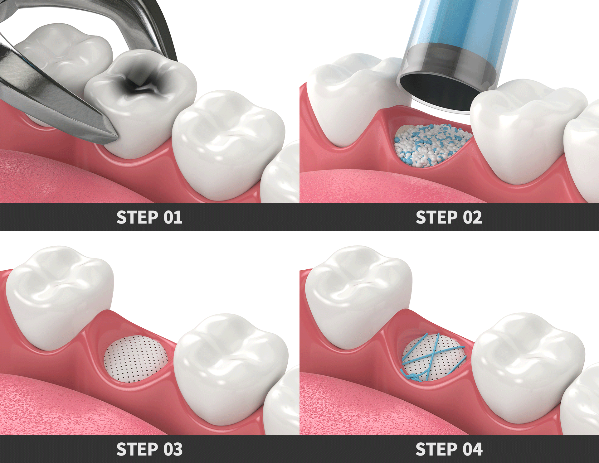 抜歯窩保存術の手順を示す画像