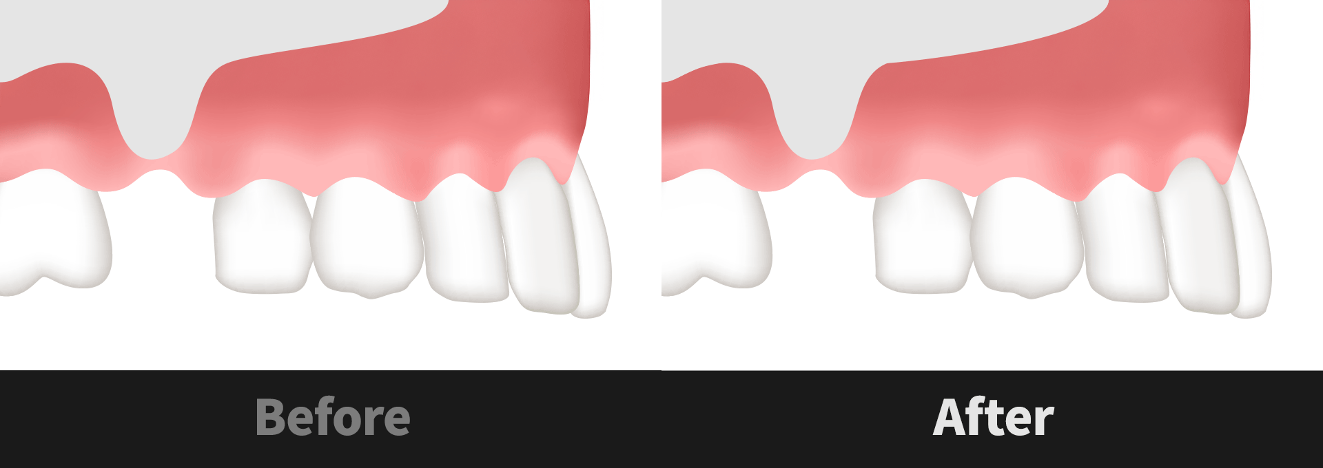 サイナスリフトの前後イメージ