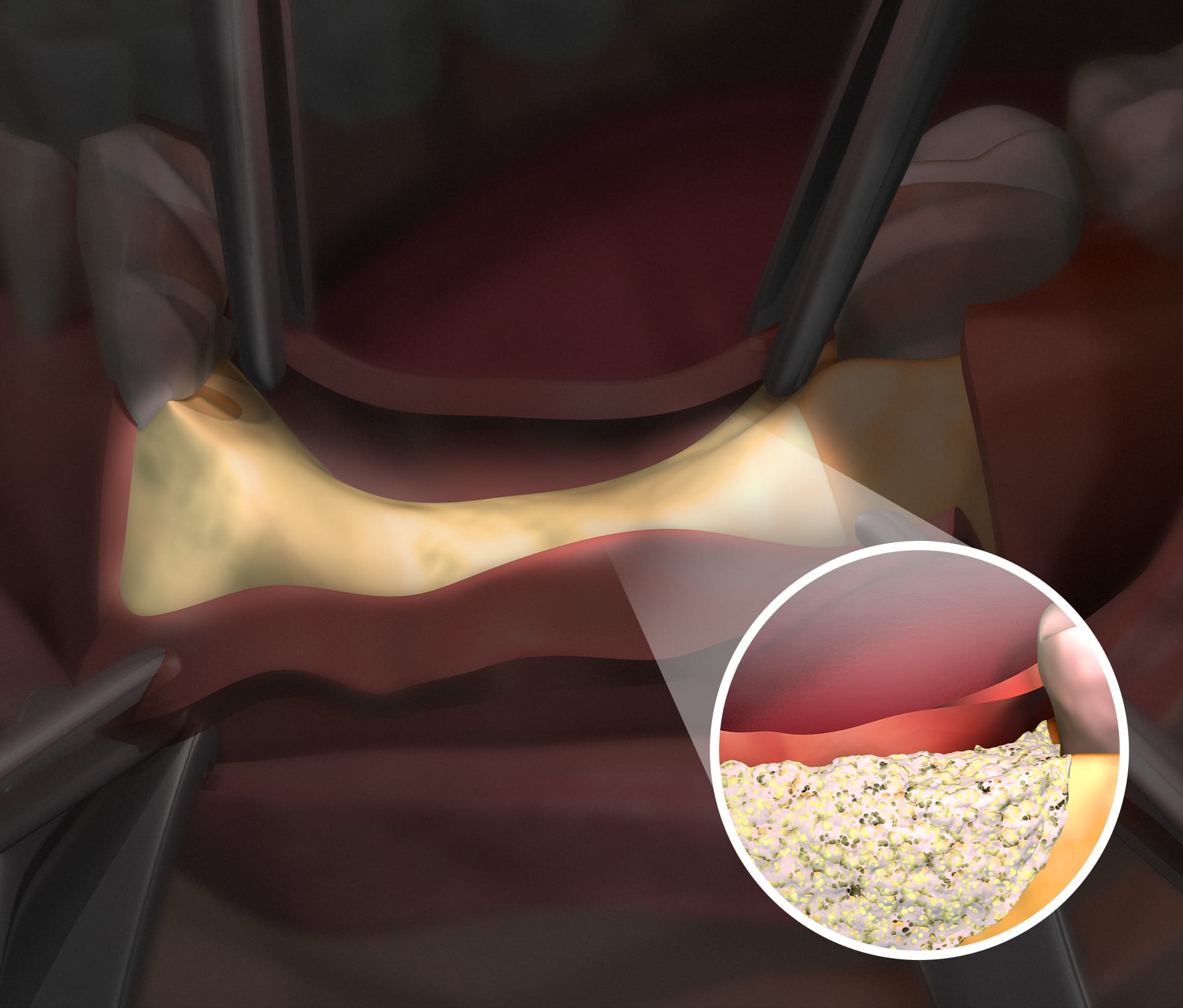 GBRによる骨造成の様子