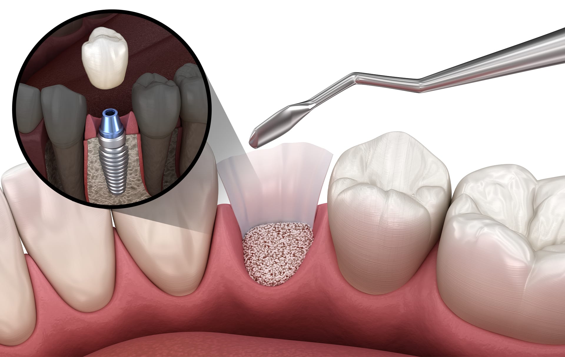骨が形成された後、インプラントを埋入する場面