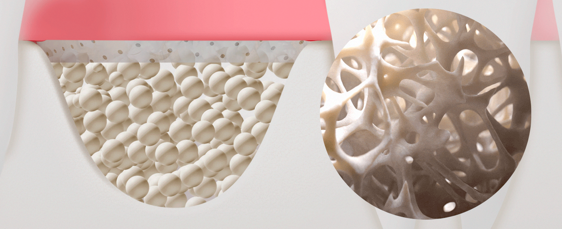 임플란트 뼈이식 후 골형성과정