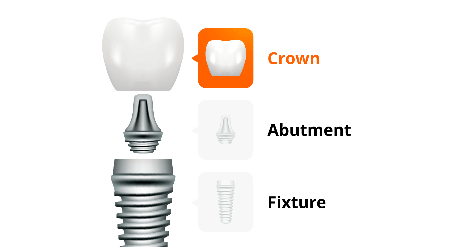 임플란트 구조를 설명한 이미지 