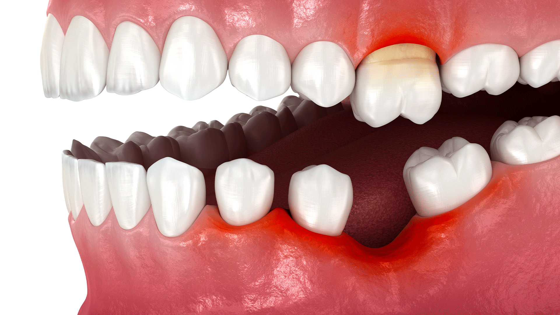 치아가 빠진 곳의  치조골이 절반 정도 흡수되어 있는 모습 