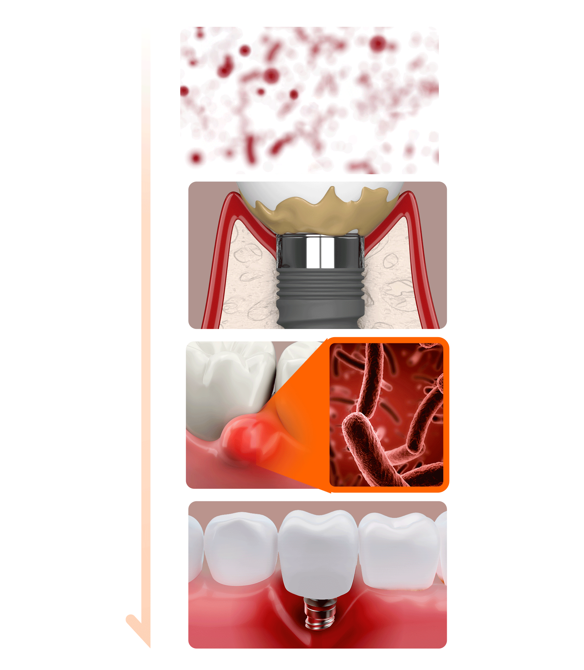 당뇨가 잇몸을 공격하는 원리를 순차적으로 표현한 인포그래픽 