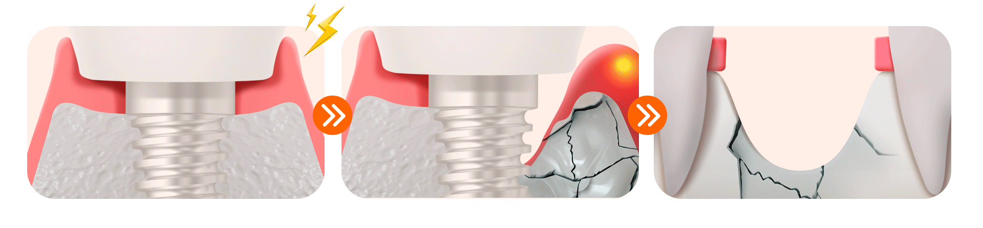 당뇨 임플란트 '방치'했을 때 벌어지는 잇몸뼈의 변화를 보여주는 이미지 