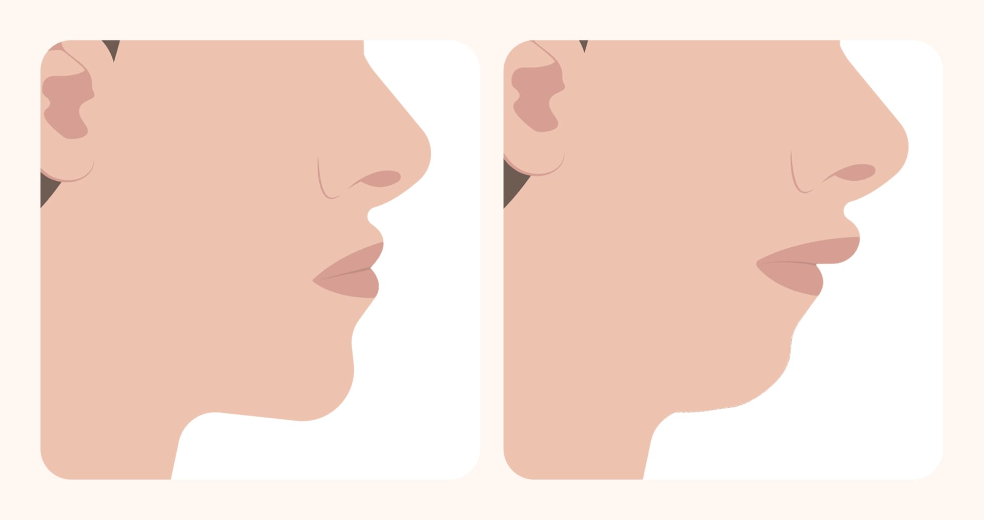 입을 벌리고 숨을 수는 구호흡 습관을 나타낸 의학적 일러스트 