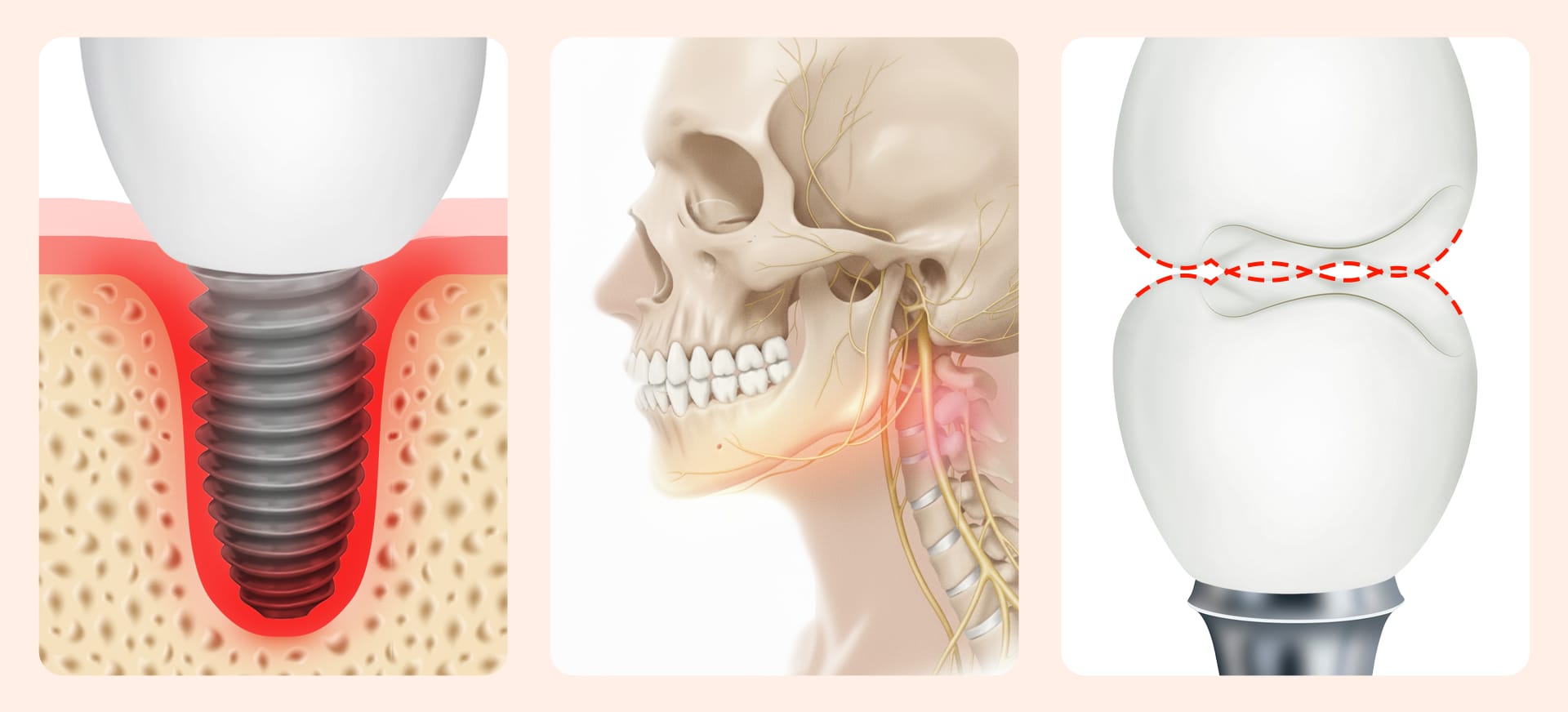 임플란트 재식립 원인 - 숙련도 부족에서 비롯된 문제를 나타낸 이미지 