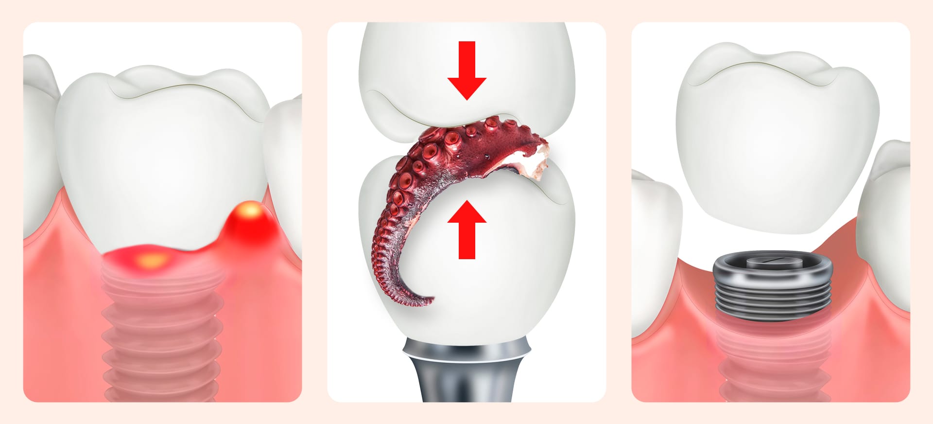 임플란트 재식립의 원인 - 관리 소홀과 생활 습관를 나타낸 이미지 