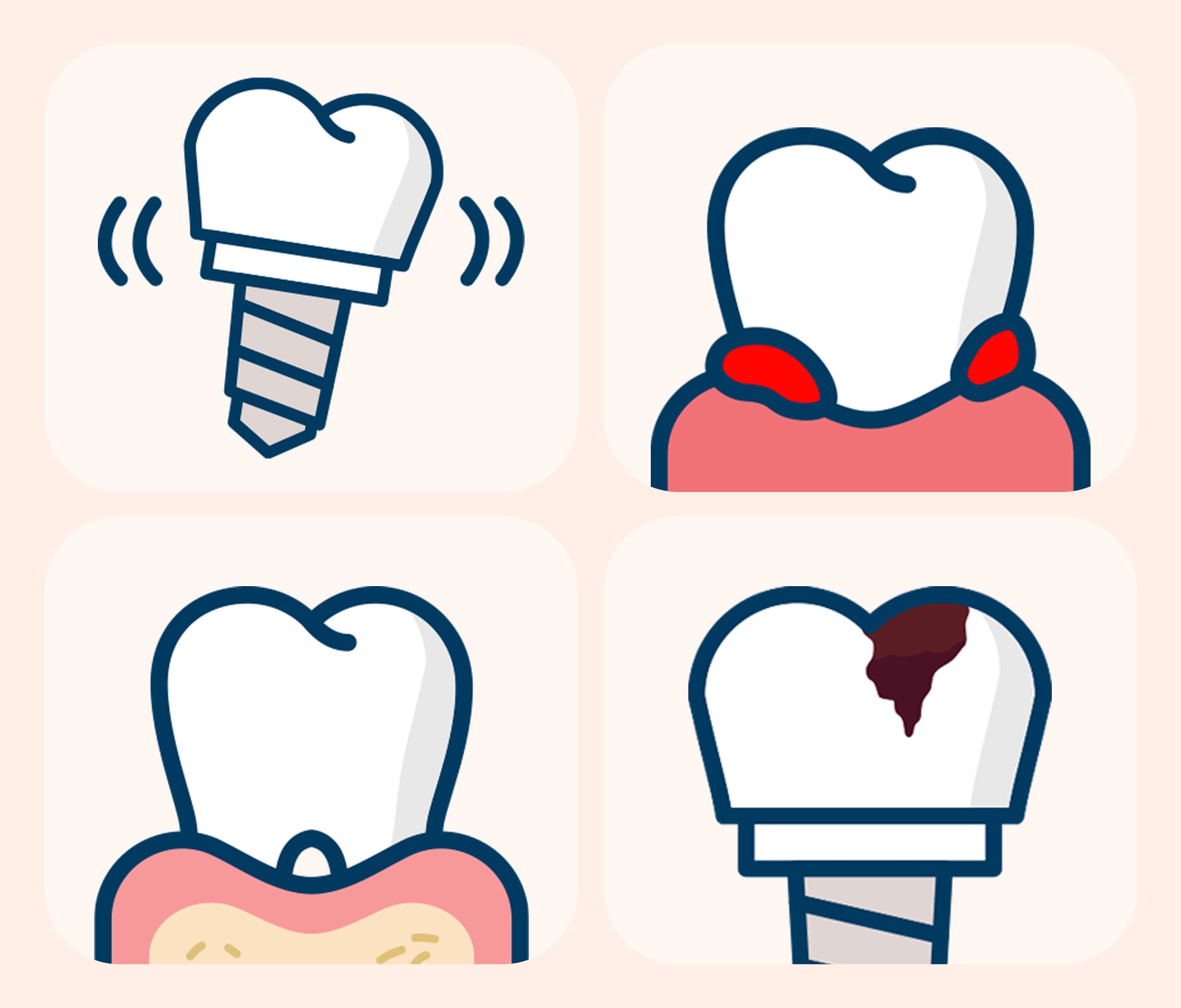 임플란트 흔들림, 통증, 잇몸 염증, 보철물 헐거움 등 임플란트 재수술이 필요한 4가지 주요 증상 