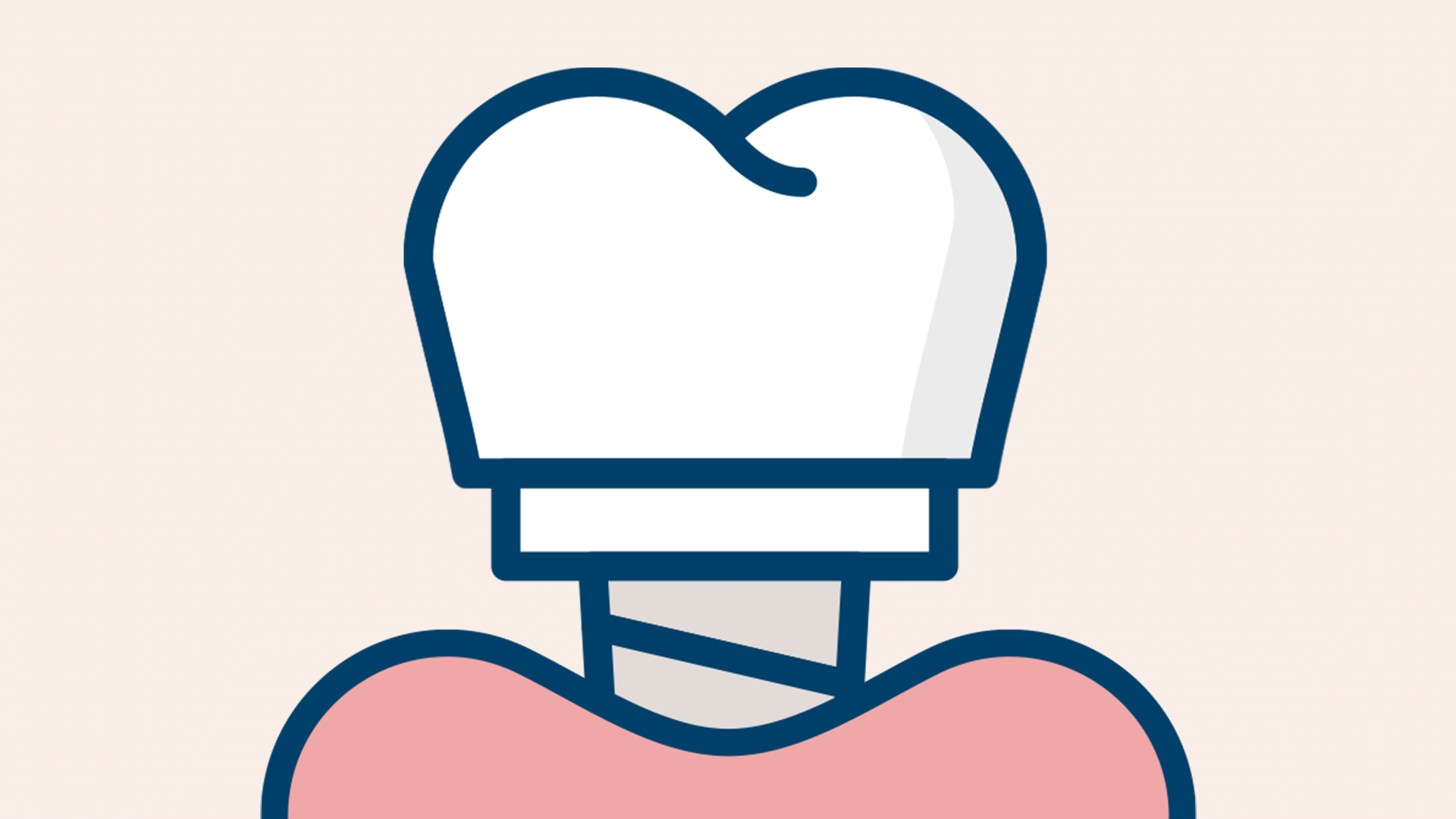 보철물이 자꾸 헐거워지고, 보기에도 이상한 경우