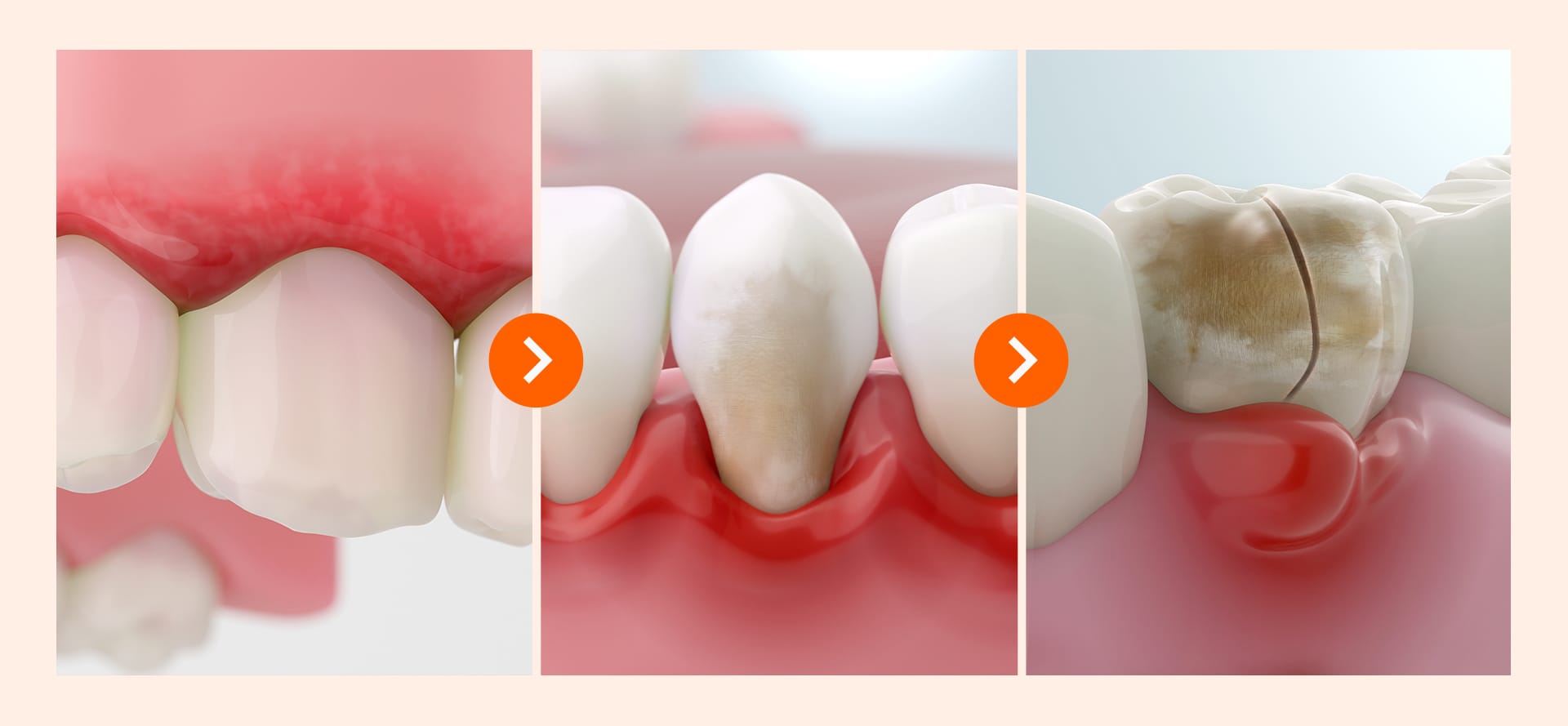 임플란트의 손상단계(초기-중기-말기)를 보여주는 이미지 
