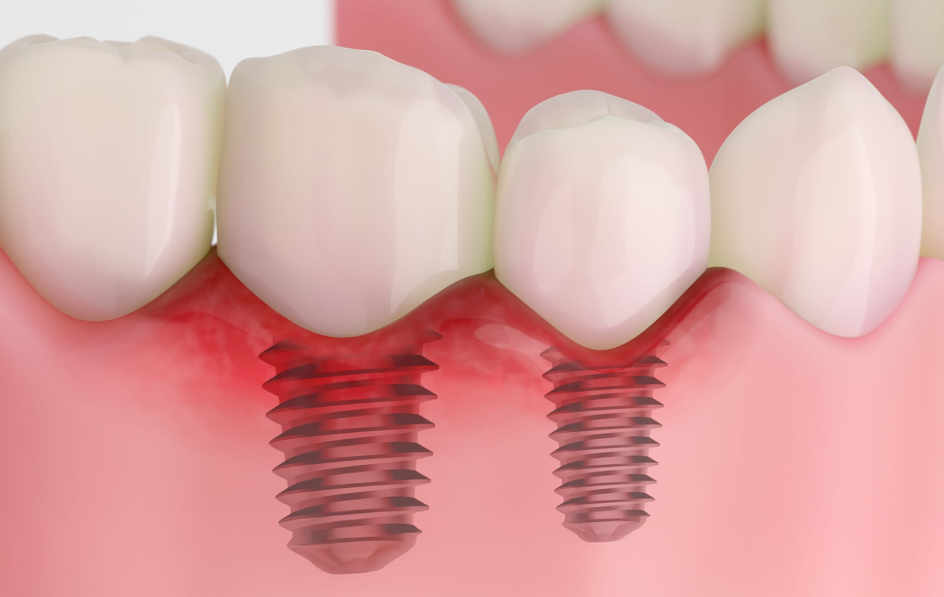 임플란트 초기 손상의 모습 