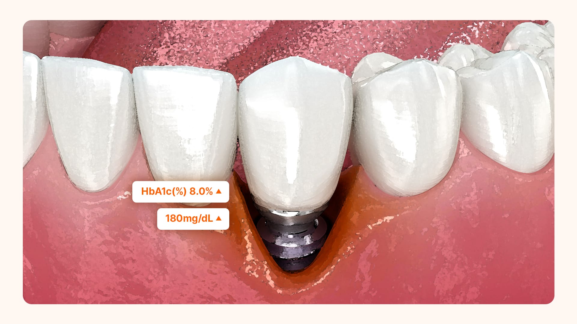 임플란트를 식립한 치아의 잇몸뼈 흡수가 시작됨을 표현하는 이미지