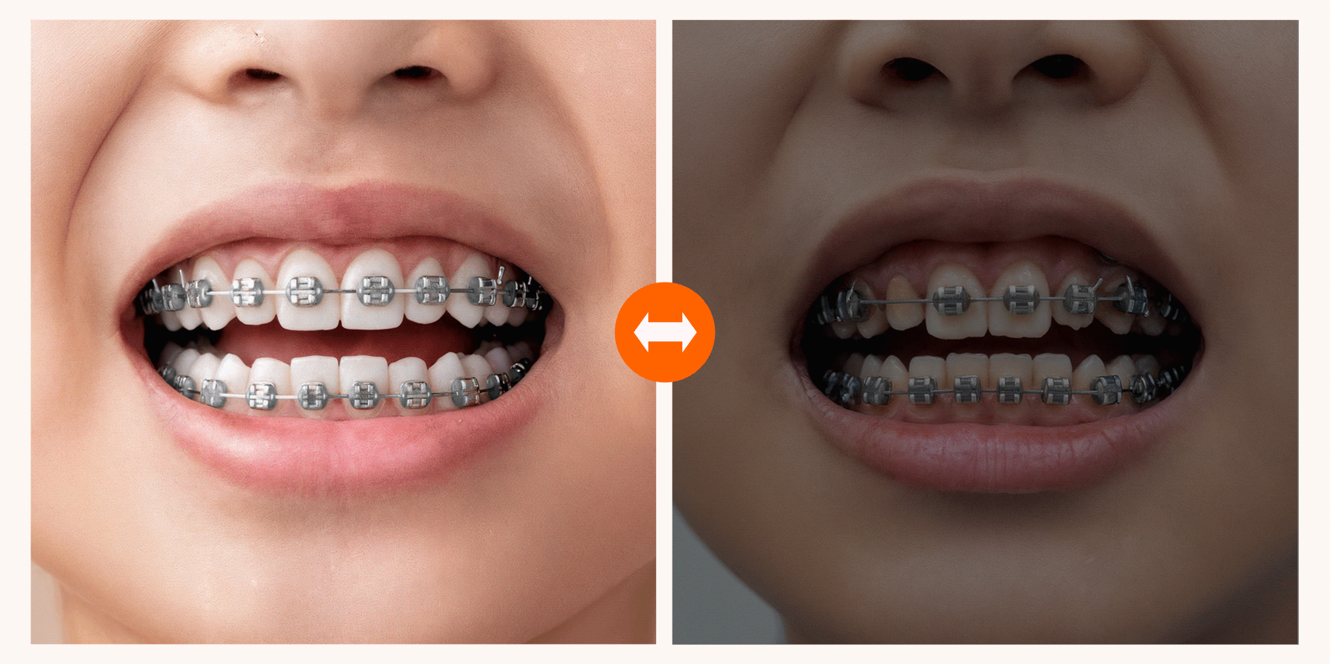 부적절한 식습관으로 인해 브라켓이 손상되거나 충치가 생겨 치료가 지연되는 부정적 결과와, 올바른 식습관으로 장치가 온전하게 유지되는 긍정적 결과를 비교한 이미지
