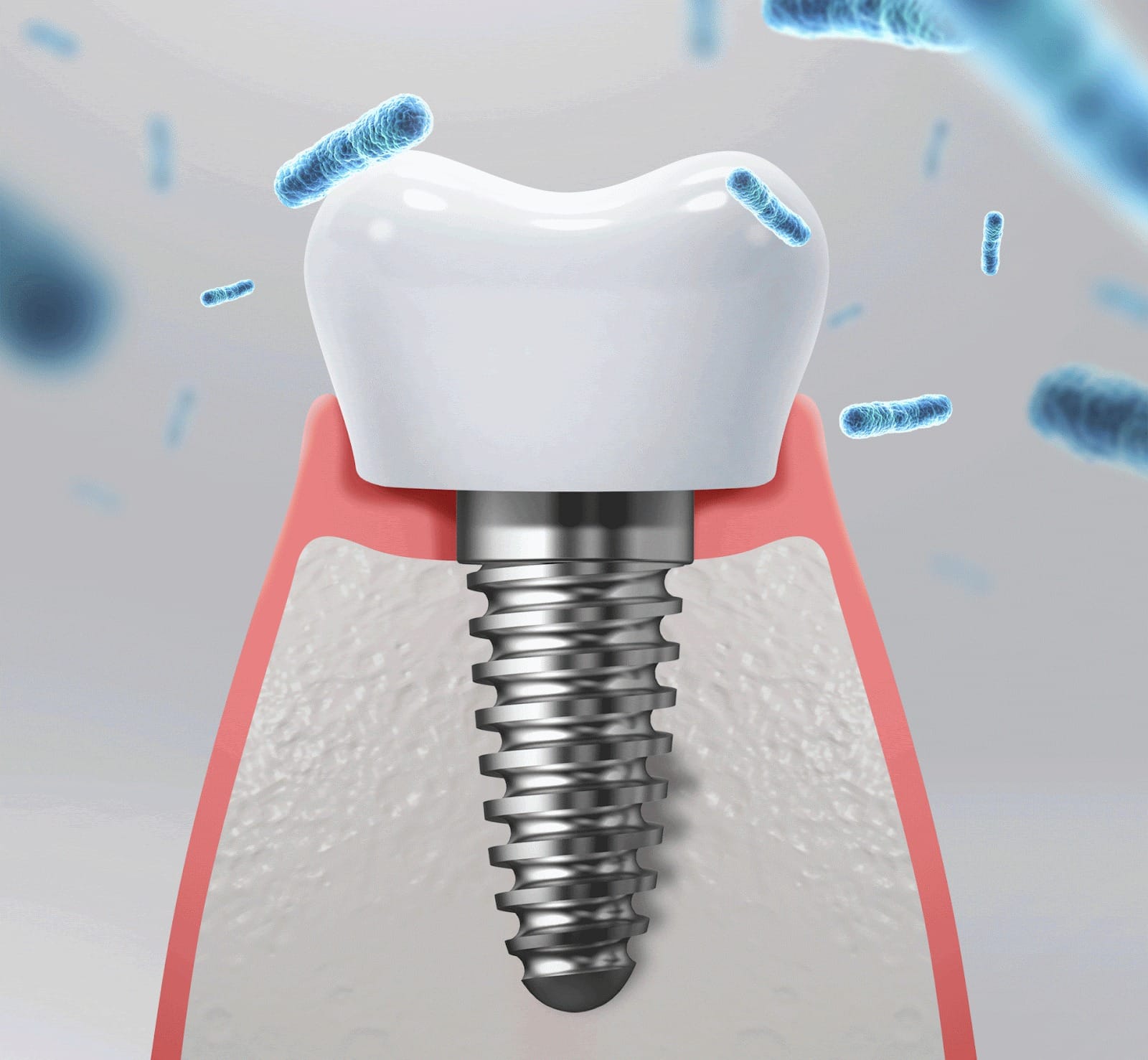 잇몸 염증의 원인이 되는 보철물 하방 잔여 시멘트와 세균막 형성 예시