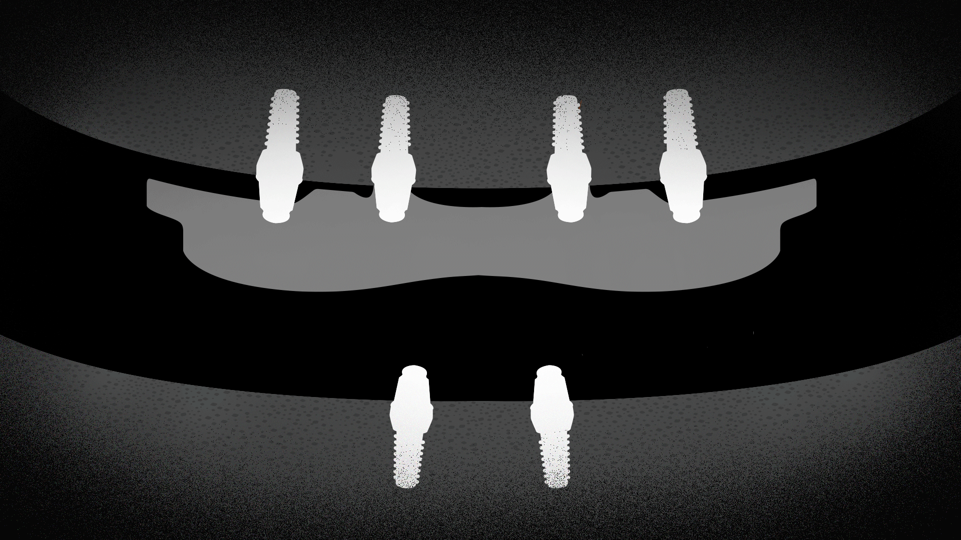 임플란트 틀니로 최소 식립해 회복한 엑스레이 사진 