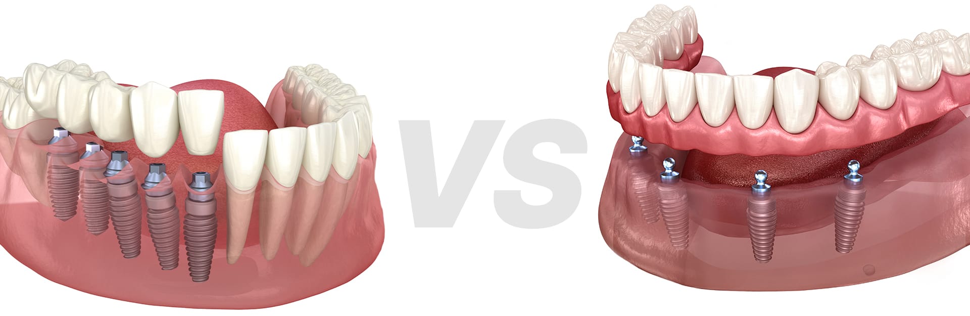 전통 전악 임플란트(다수 식립)와 디지털 풀아치(최소 식립)의 차이를 오브제로 비교한 이미지