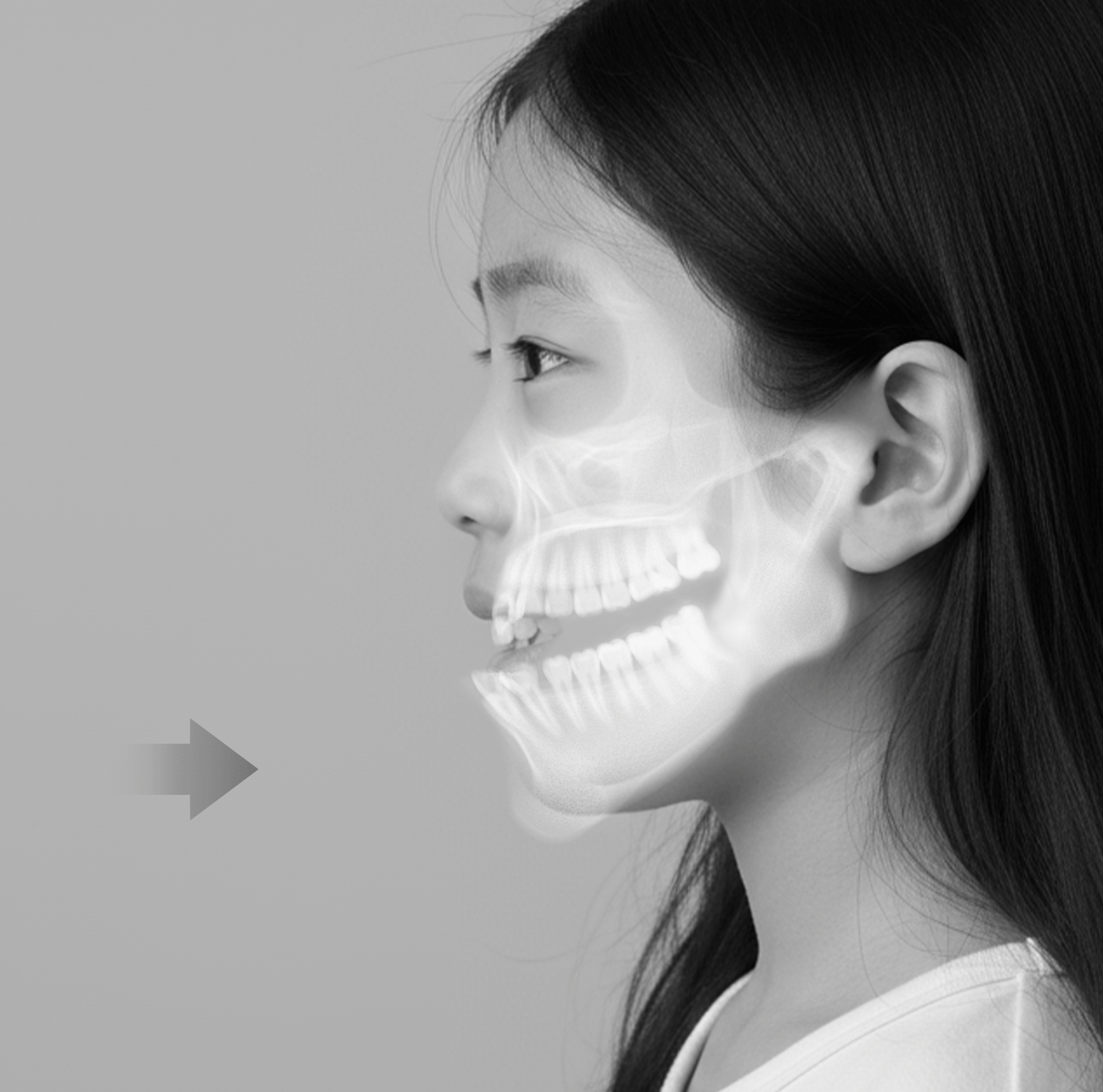 성장기 교정의 목표인 턱뼈의 성장 방향 조절을 통해 주걱턱 등의 골격 불균형이 개선되는 과정을 보여주는 소아 얼굴 측면의 움직이는 일러스트