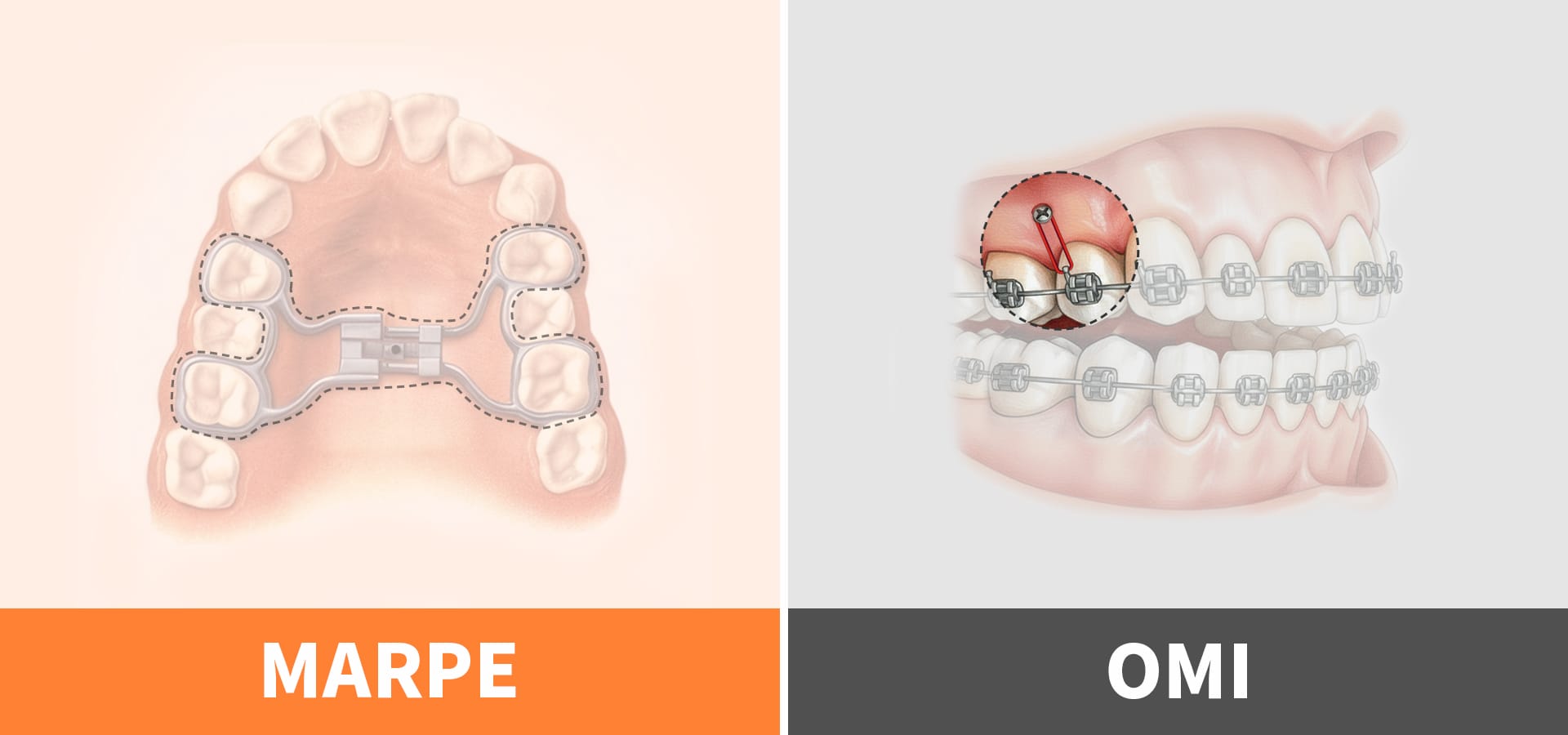 성인 교정에서 비수술적 접근을 가능하게 하는 미니스크류(TADs)와 비수술 상악 확장 장치(MARPE)가 장착된 모습을 보여주는 일러스트