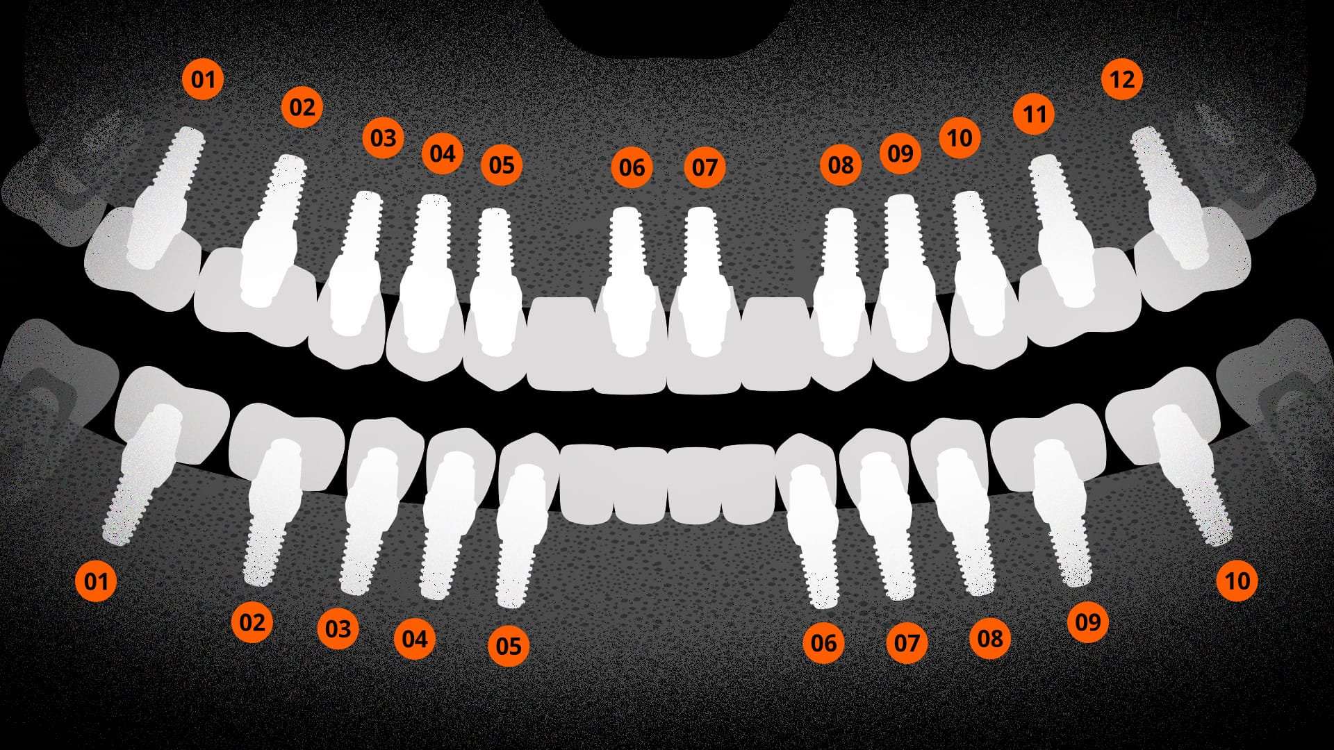 최대 식립으로 자연치아 수준 회복한 엑스레이 사진 