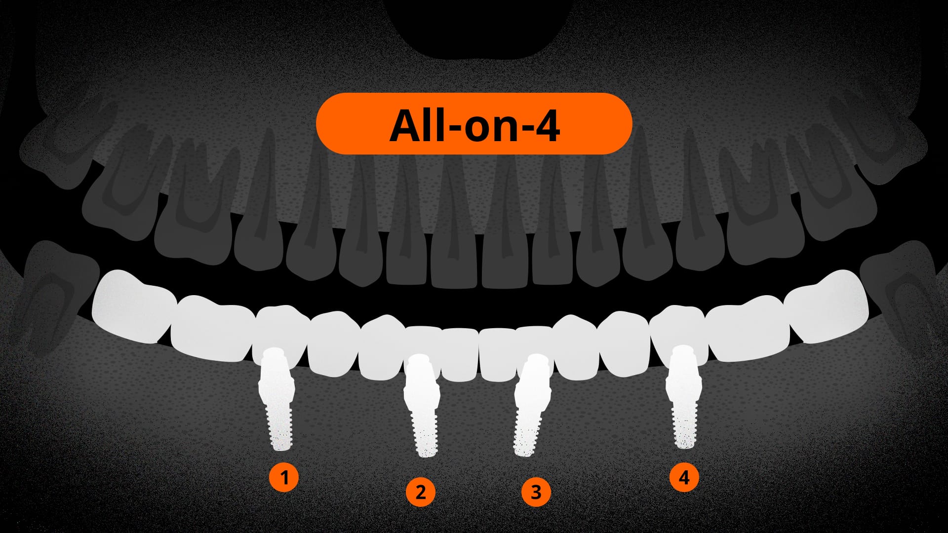 올온포 식립된 엑스레이 사진 